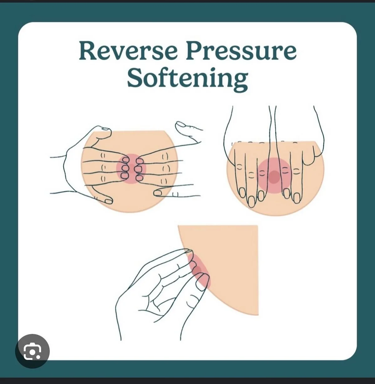 🤱 REVERSE PRESSURE SOFTENING (RPS): A Game-Changer for Engorgement Relief 💧

Struggling with breast engorgement and a baby who can&rsquo;t latch? Your secret weapon = Reverse Pressure Softening 💥

This simple technique:
🔄 Uses gentle finger press