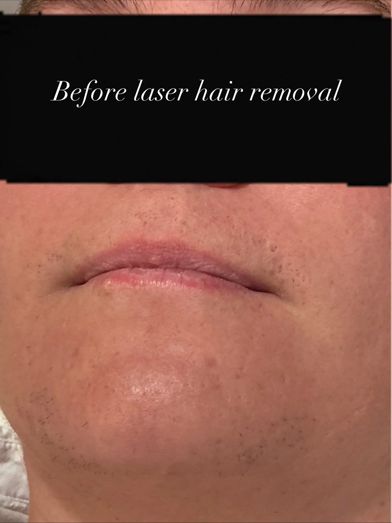 Real results after just ONE laser session! ⚡️✨

Our lovely client, who has PCOS, saw an incredible reduction in unwanted hair after her very first laser treatment &mdash; and she couldn&rsquo;t be happier! 💖

Laser hair removal is one of the most ef