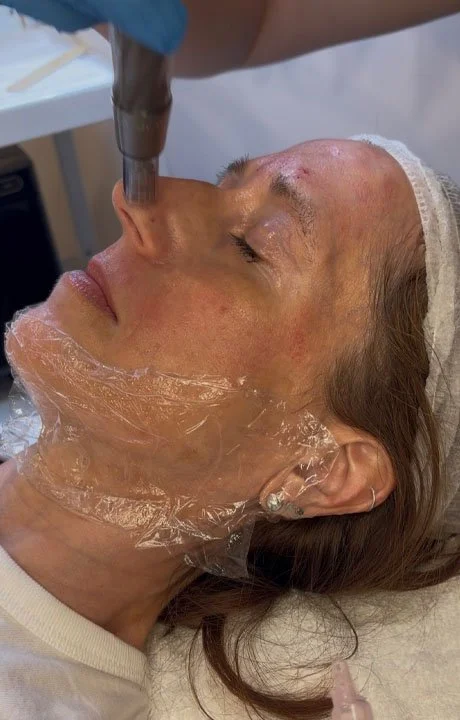 microneedling for reduced pore size in Calgary
