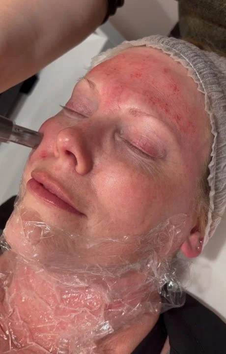 during microneedling process in Calgary