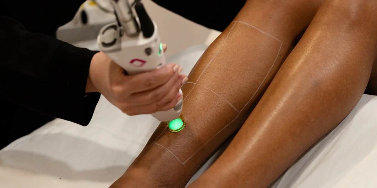 laser hair removal treatment on legs at Calgary skin clinic