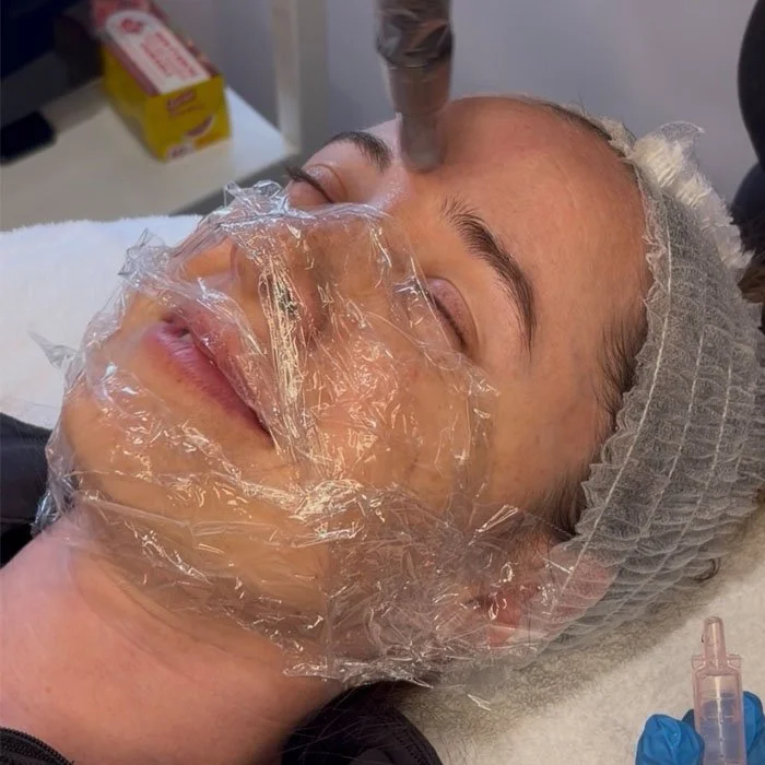 downtown Calgary microneedling session