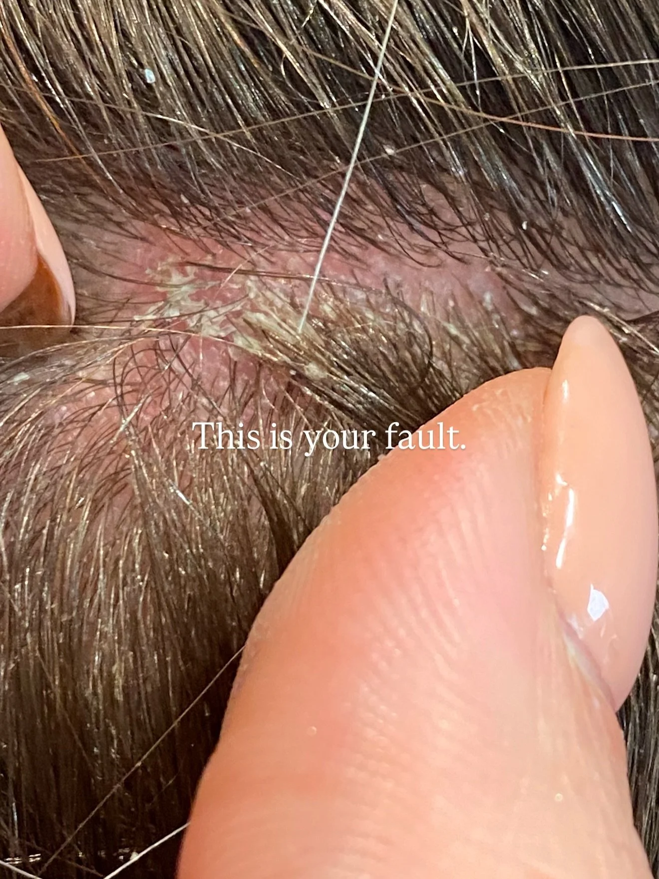 This is not normal.
But we can prevent it.

That&rsquo;s erythema, sebaceous overproduction &amp; follicle dilation&hellip;

a trifecta of inflammation, occlusion &amp; mechanical trauma.

Unfortunately&hellip;
We call it negligence.

That constant p