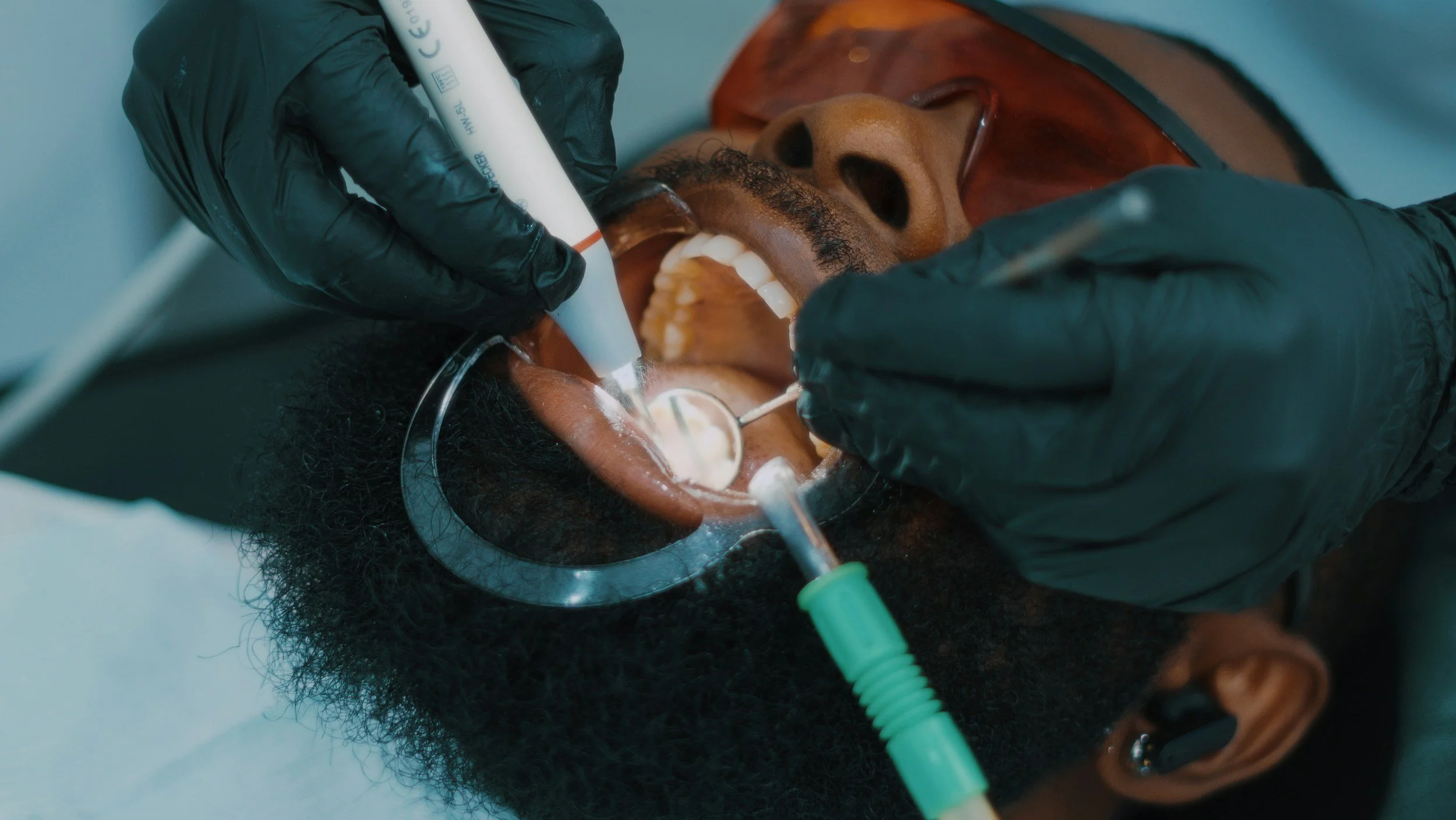 Do I Need a Filling or a Crown? A Spokane Valley Dentist Explains