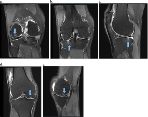 Intraosseous Orthobiologics: A New Frontier in Knee Osteoarthritis Care in Bend, Oregon