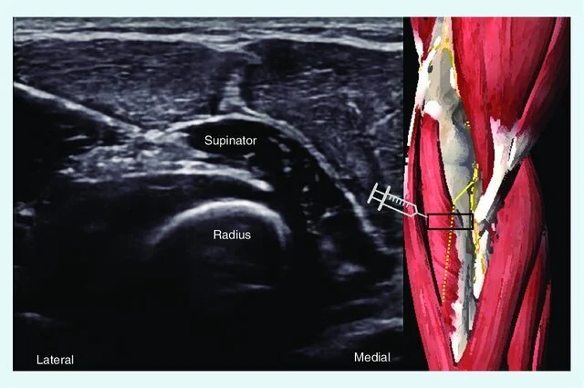 Medical illustration showing ultrasound image and anatomy of the shoulder, highlighting the suprinator muscle and the radius bone, with the insertion of a surgical anchor into the bone.