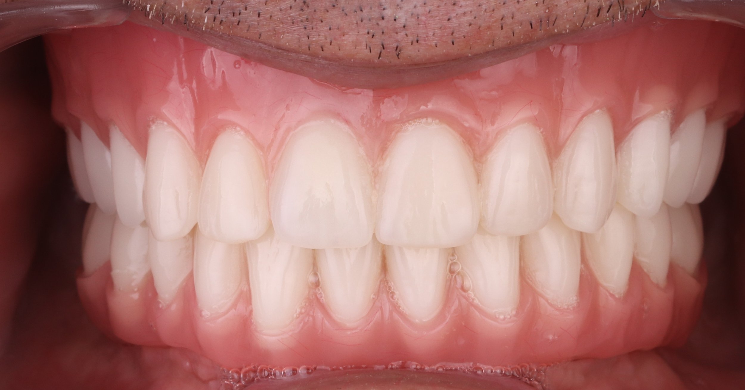 Full set of teeth on dental implants.