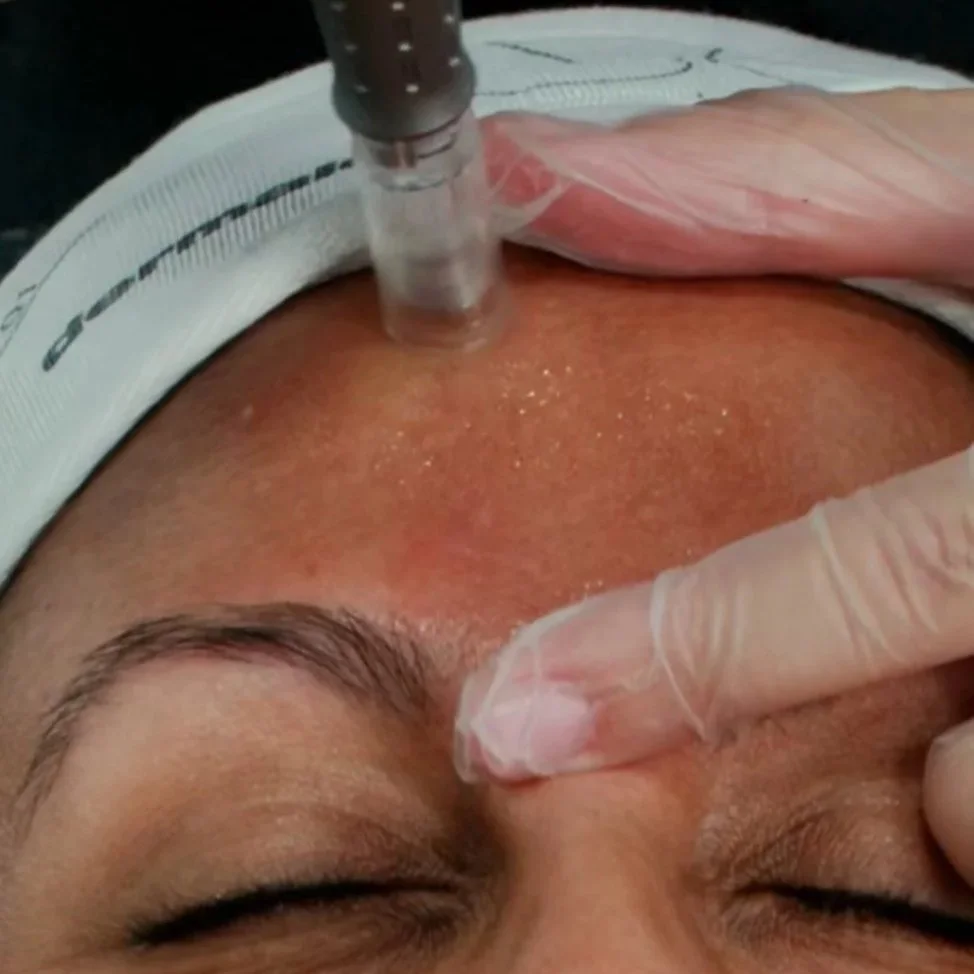 Microneedling Facial