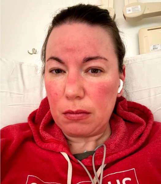 my face turns red during ketamine infusions