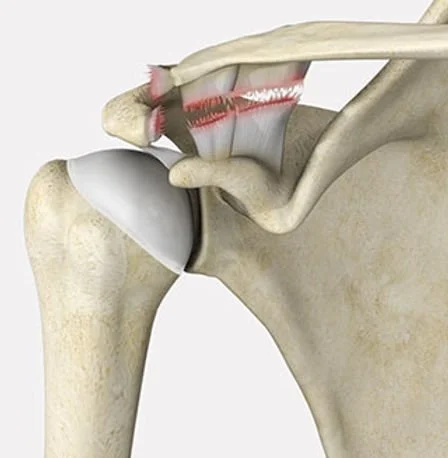 An anatomical illustration of the shoulder joint showing bones, cartilage, and muscles, focusing on the shoulder and upper arm.