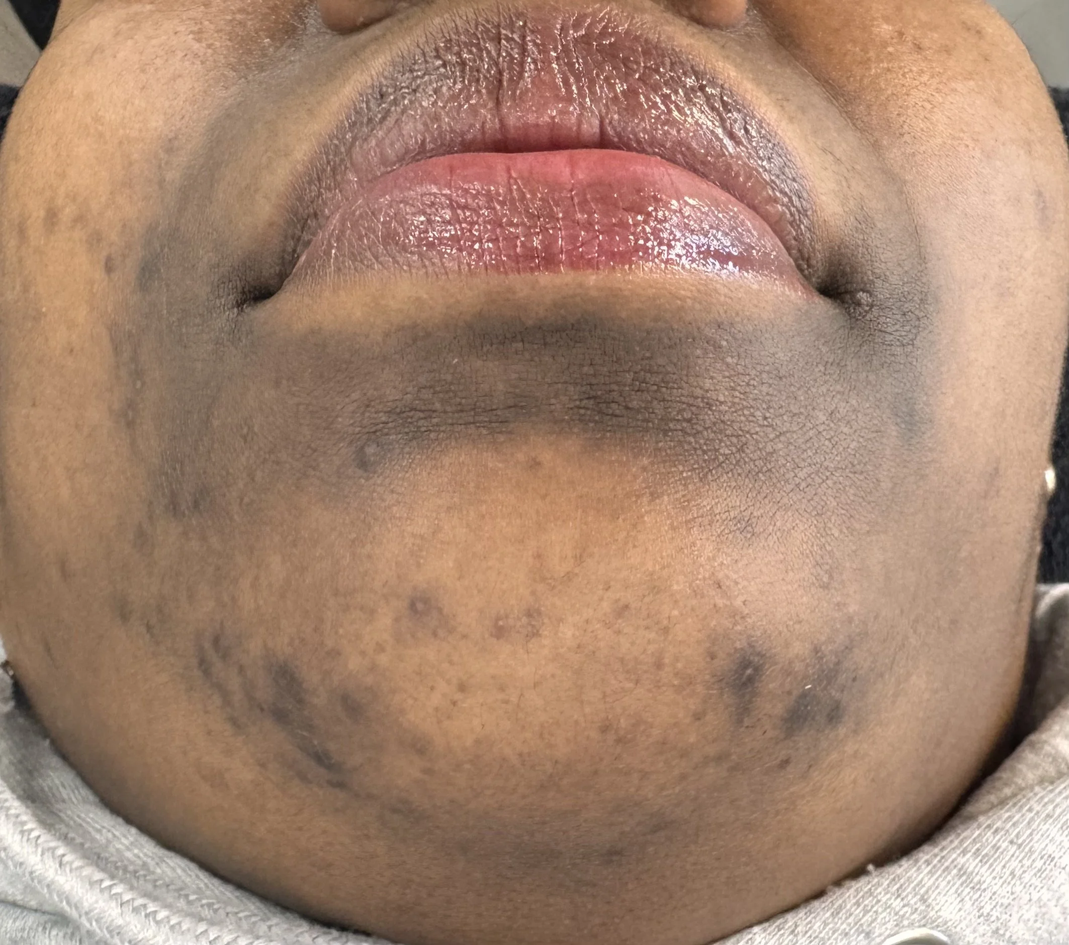 Why Are Your Dark Spots Darker Right Now?