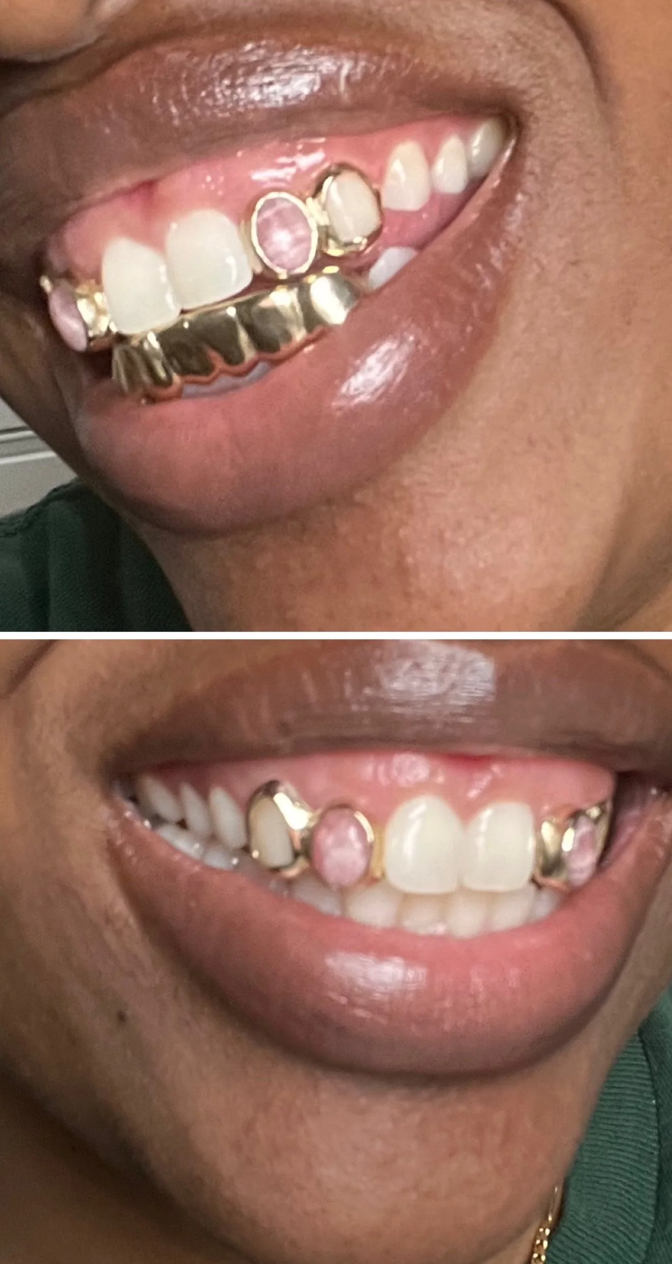 Close-up of a person's mouth showing 6pc bottom and 2pc top grillz with stone on the south side of Chicago.