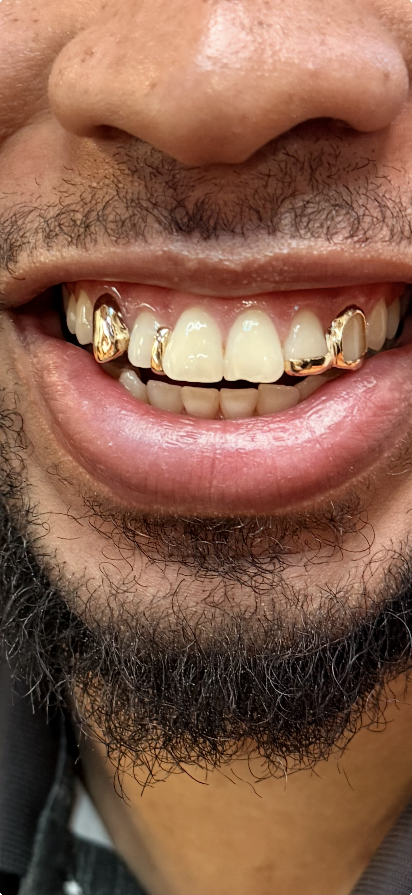 Why Some Grillz Don’t Fit: How to Improve Your Chances of Getting Grillz That Fit Right