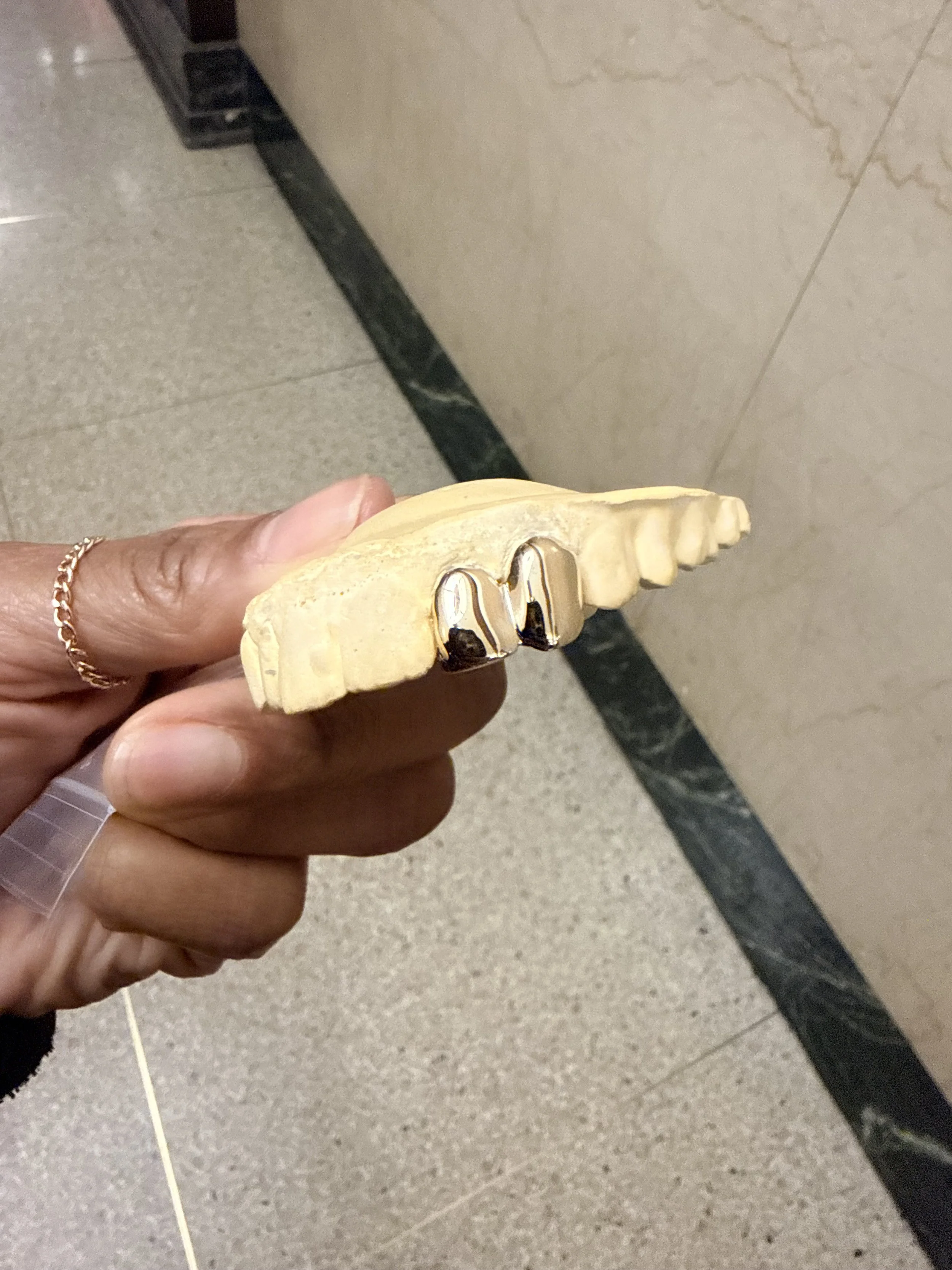 A hand holding a dental mold with two gold dental crowns on two front teeth.