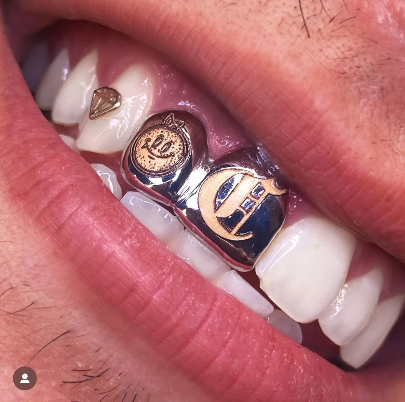 Close-up of a person's mouth showing upper teeth with shiny, metallic dental caps or grillz. The caps are engraved with intricate designs, including a smiley face and the letter 'E'.