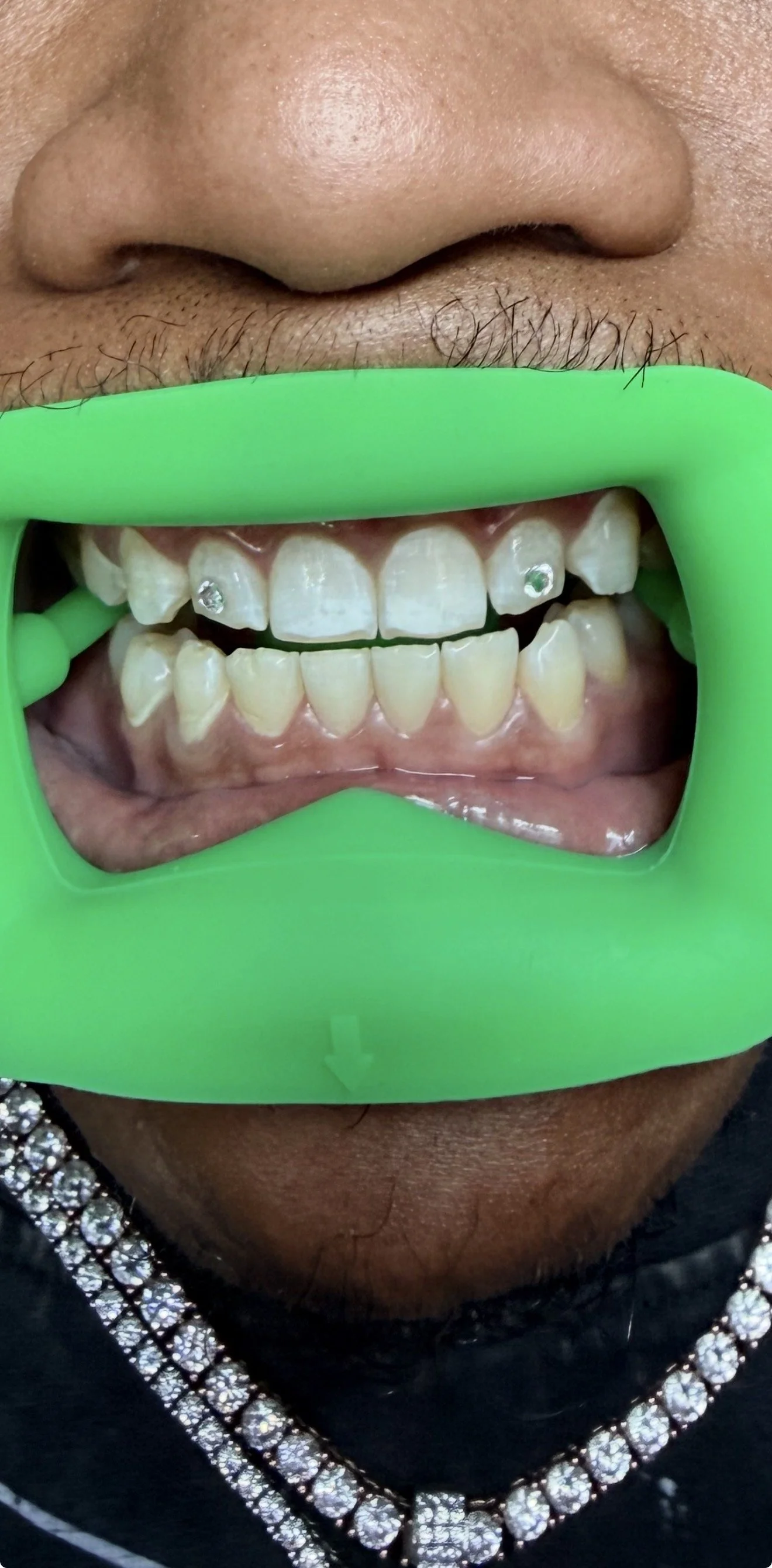 close up of tooth gems in Chicago on two lateral teeth