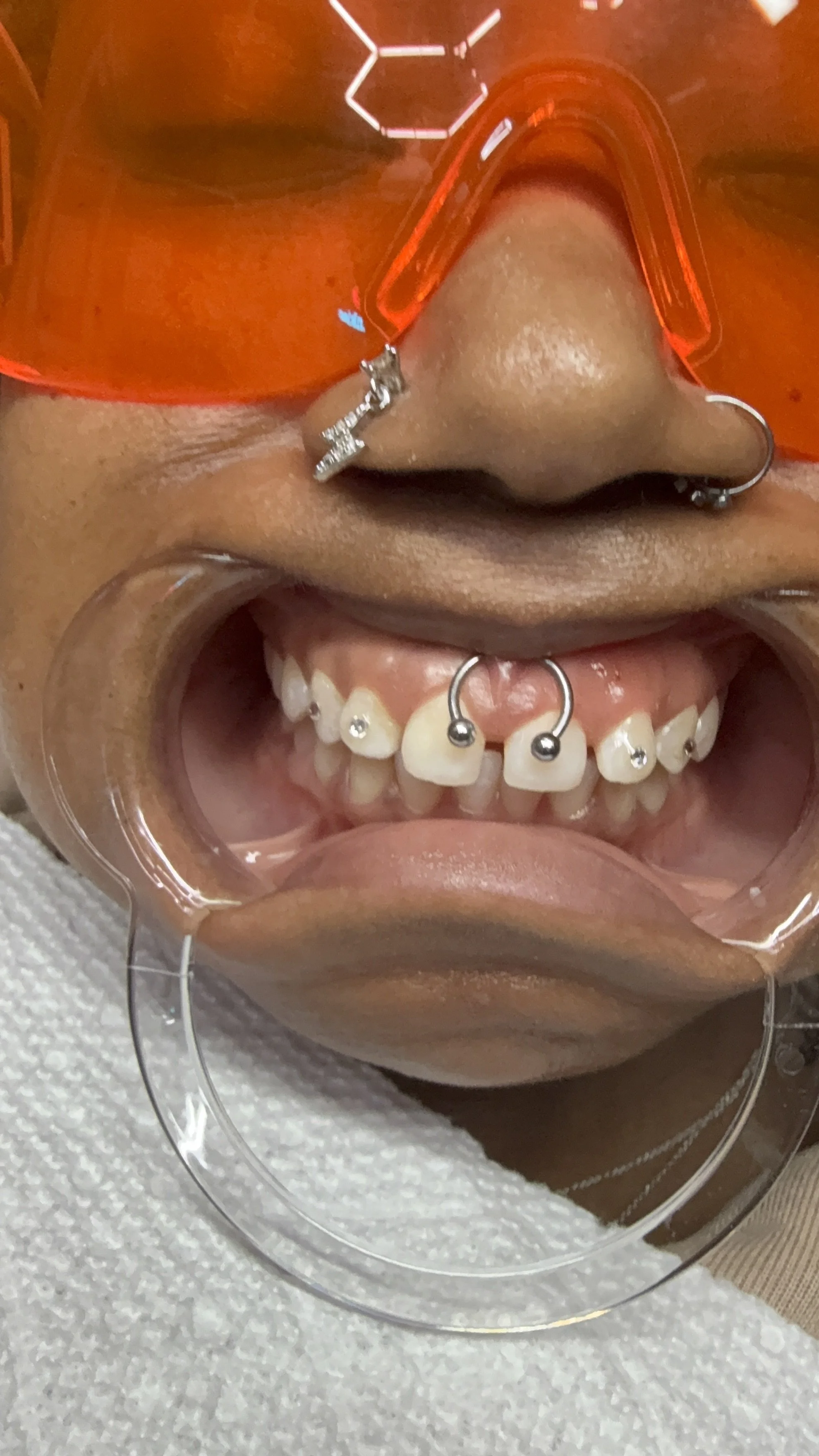 smile with freestyle tooth gems in chicago