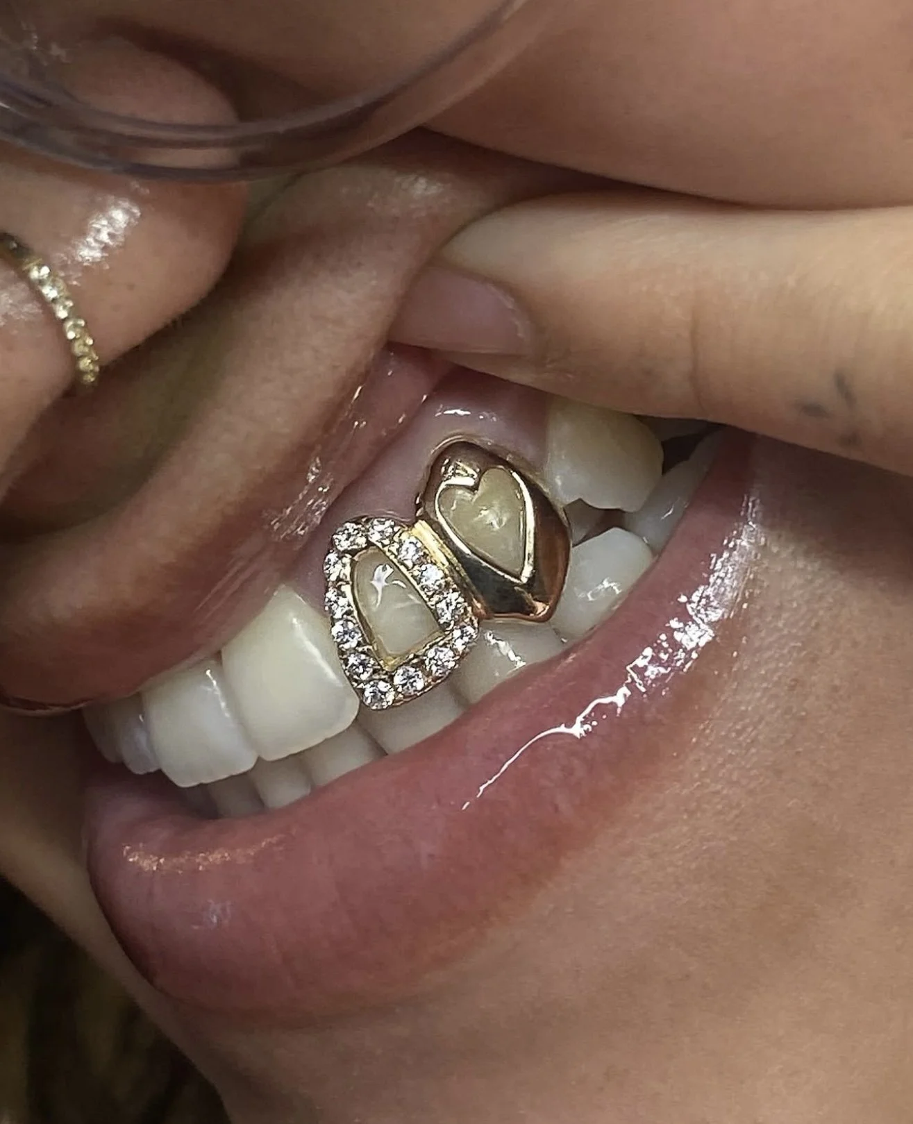 Close-up of a person's mouth showing teeth with decorative jewelry, including a heart-shaped gold grillz  and a diamond-studded open face frame, on front teeth.