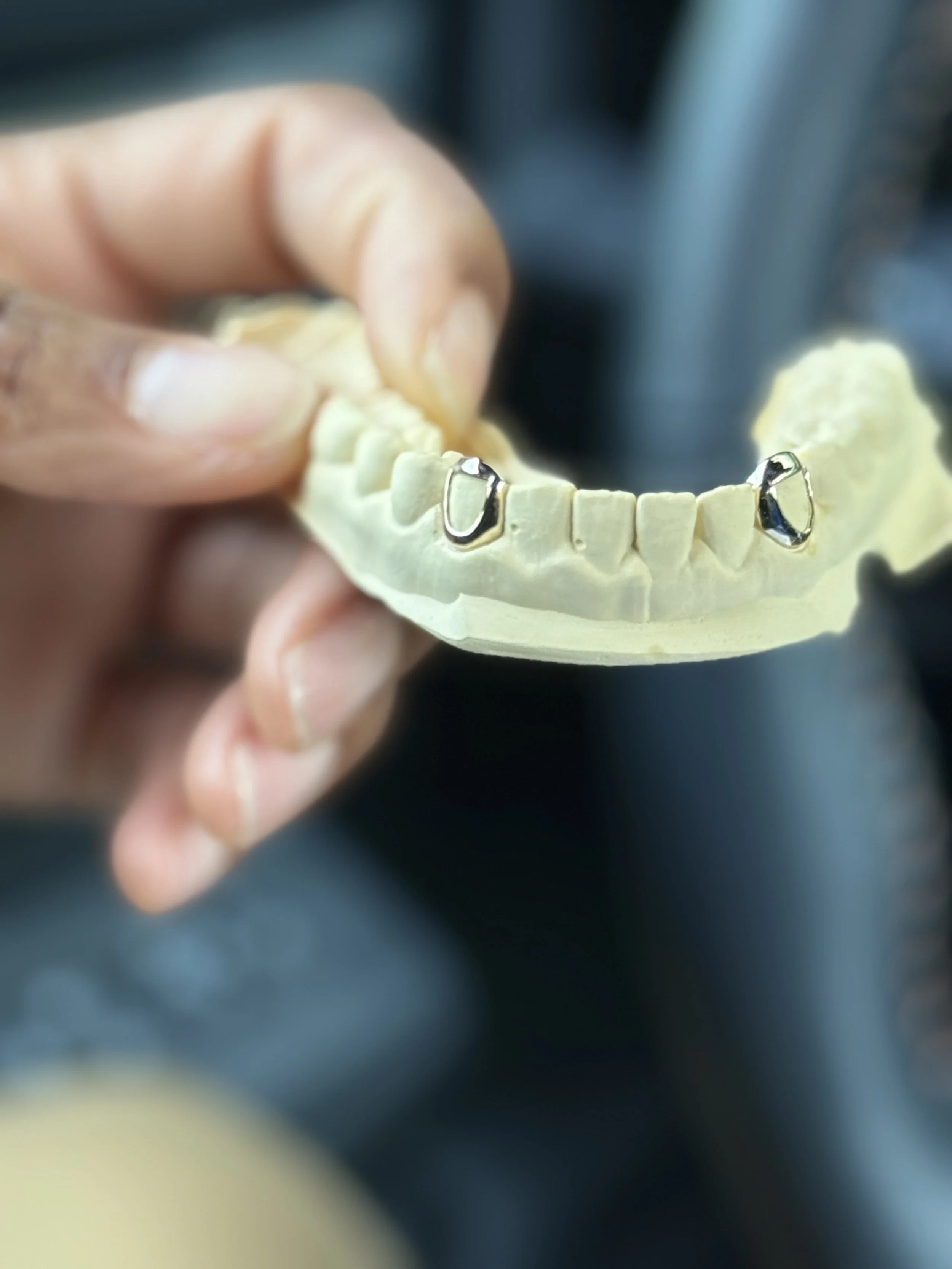 A person's hand holding a dental mold  with two separate grillz caps on the south side of Chicago.