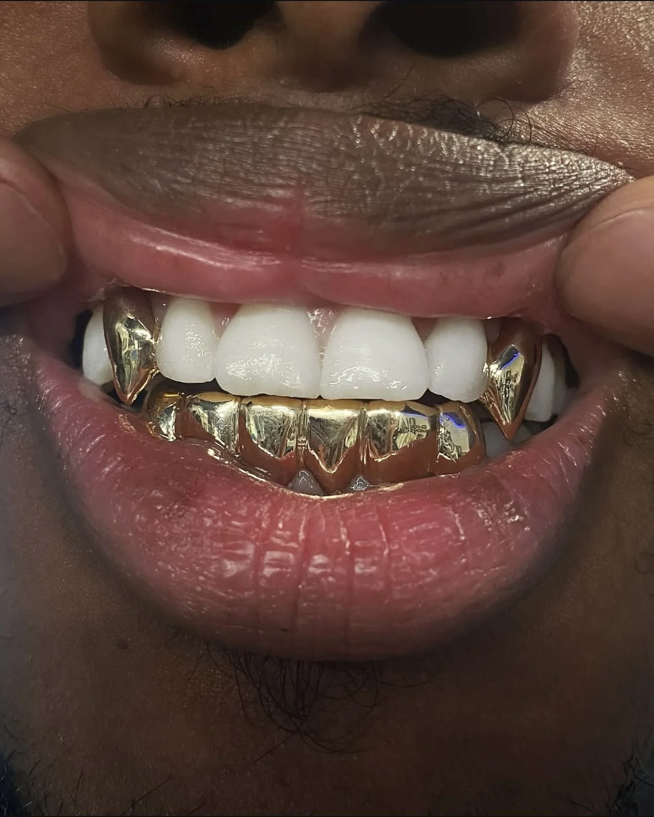 Close-up of a person's mouth showing gold 6pc bottom grillz and 2pc double fang grillz.