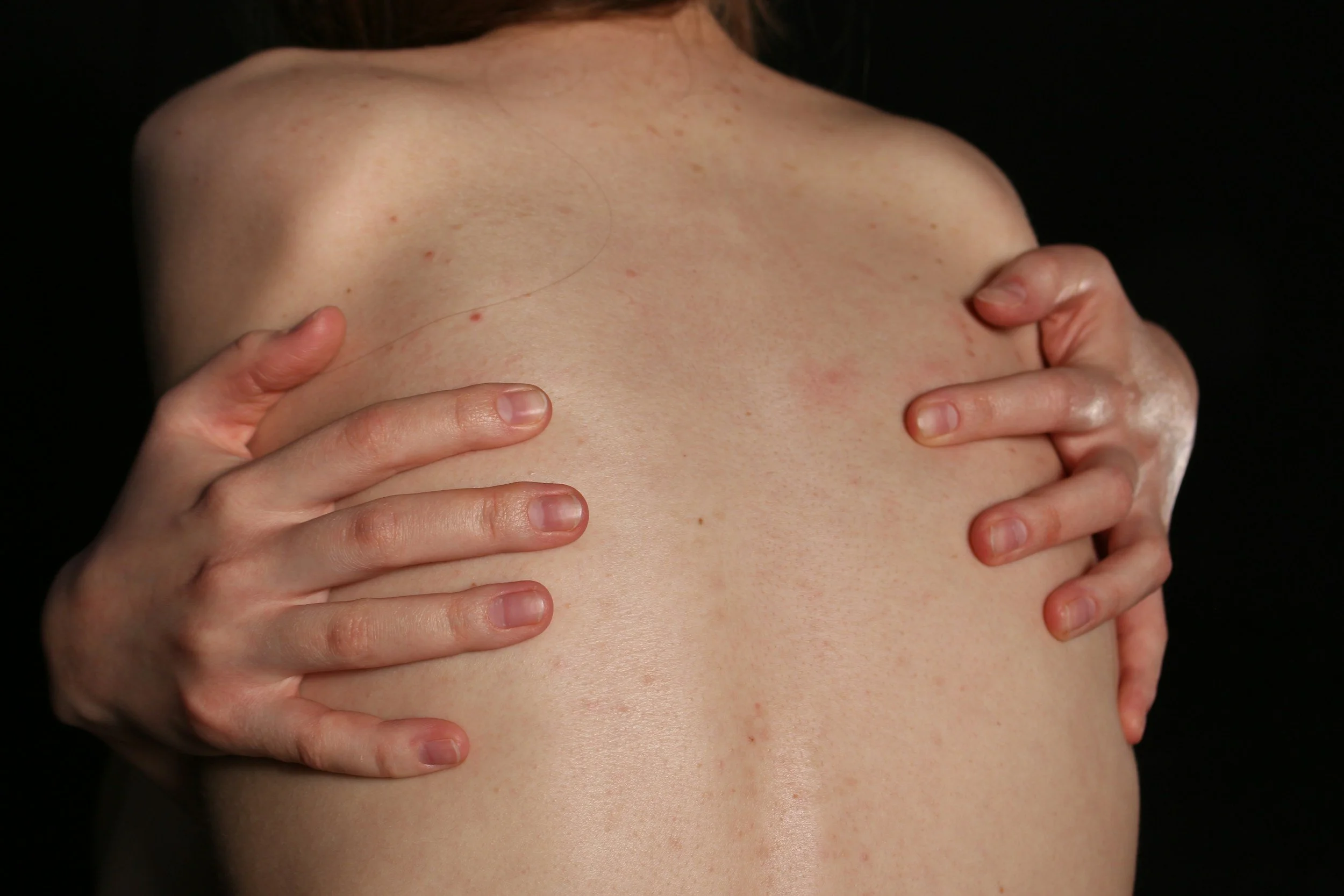 Scoliosis: What It Actually Means for Your Spine (And When Decompression Can Help)I