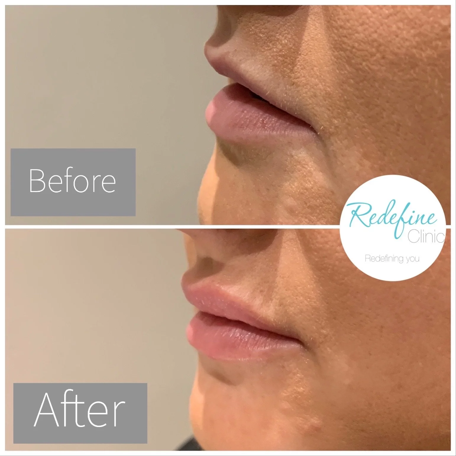 Close-up of a woman's lips and lower face showing before and after facial treatment results, with the 'Before' image above and 'After' below. The image is from Redefine Clinic.