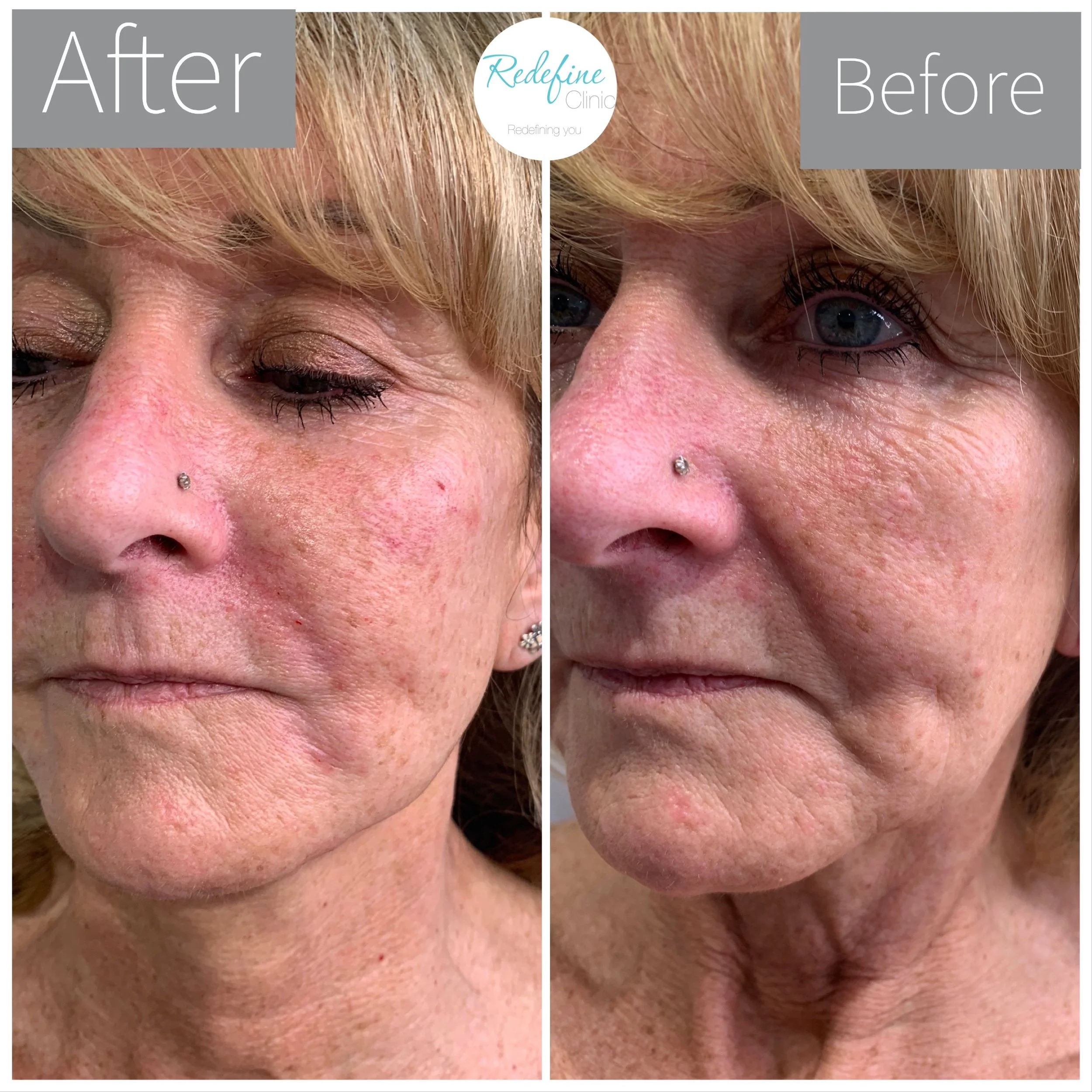 Comparison of a person's eye area before and after cosmetic or skincare treatment, showing improved skin texture and appearance.