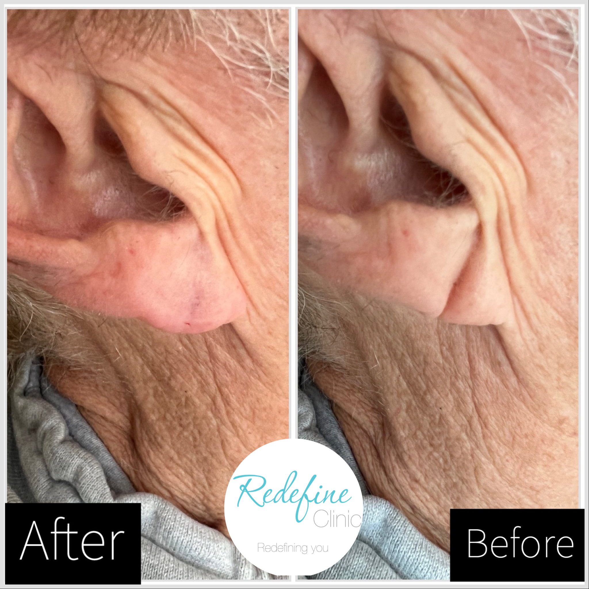 Close-up image showing the after and before results of a cosmetic procedure on an elderly person's face, highlighting skin texture and wrinkles, with text overlay saying 'Revolutionizing Aging.'