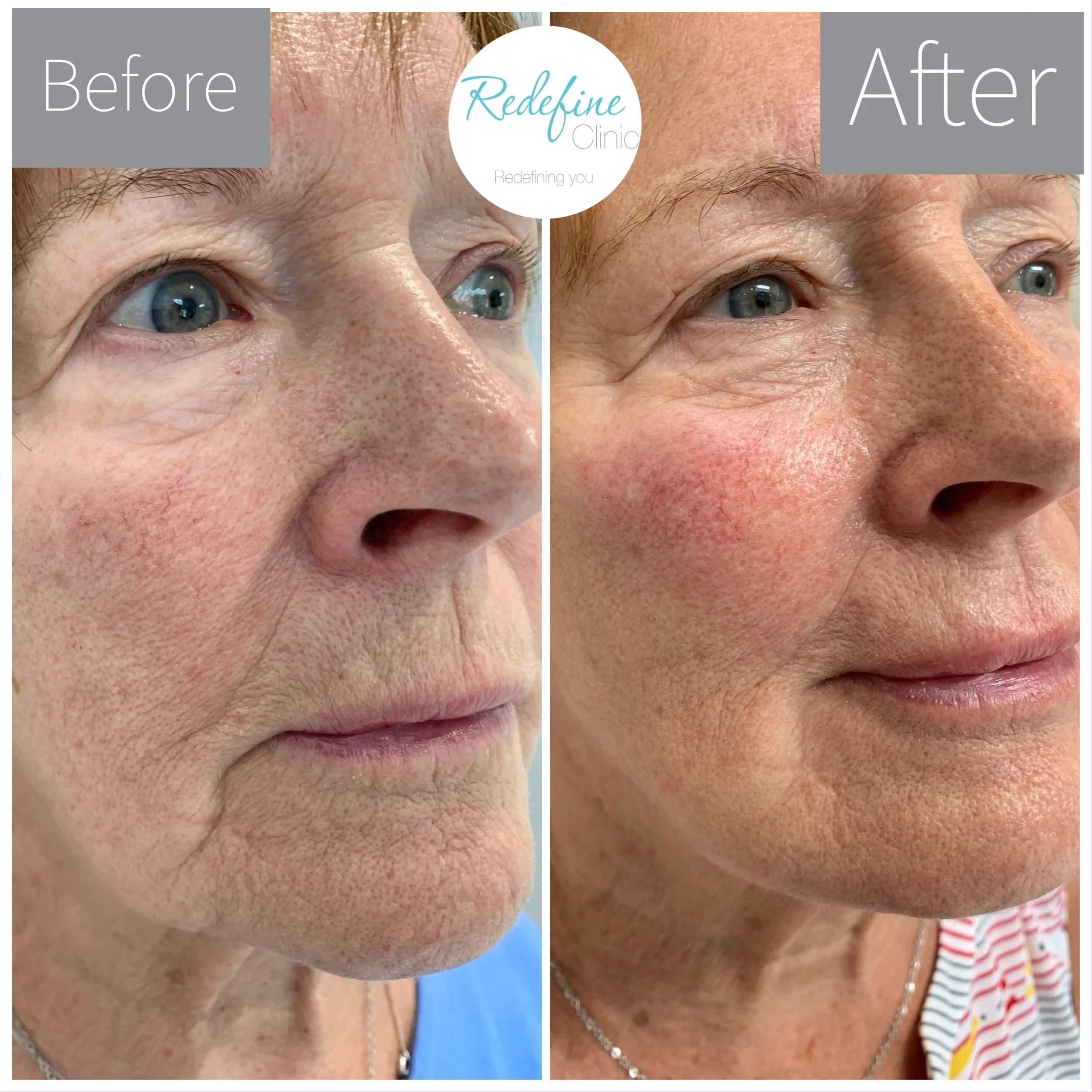 Side-by-side comparison of a woman's face before and after skincare treatment, focusing on improved skin texture and reduced wrinkles around the eye and cheek area.