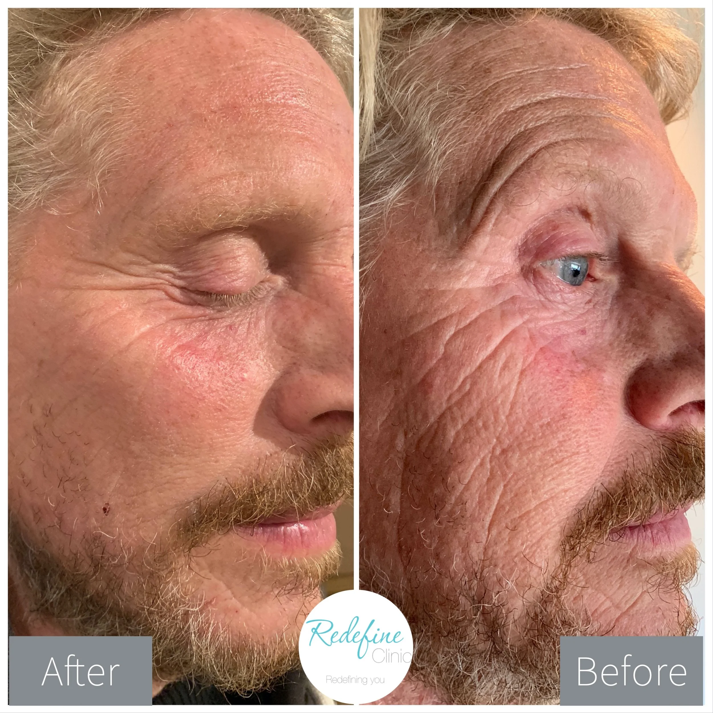 Close-up comparison of a man's eyebrow and upper eyelid area, showing improved skin texture and reduced wrinkles after treatment, with labels 'Before' on the right and 'After' on the left.