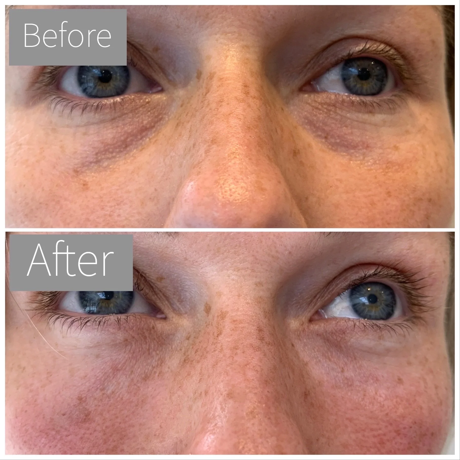 Close-up of a person's face showing blue eyes, fair skin with freckles, and some redness on the nose and cheeks. The image is labeled 'Before' and 'After,' indicating a comparison, possibly related to skin treatment or cosmetic procedure.