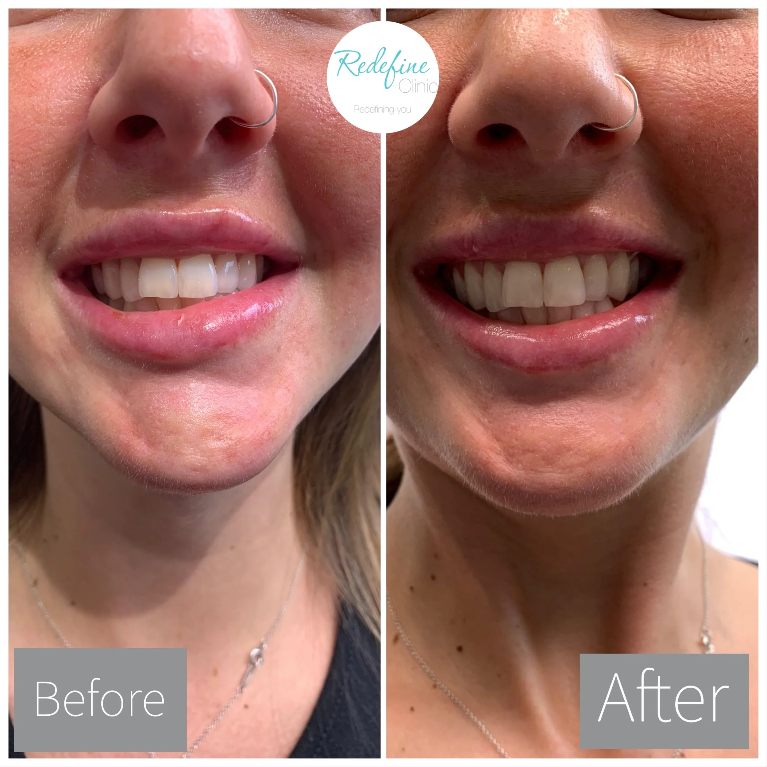 Side-by-side comparison of a person's nose and mouth before and after cosmetic treatment, showcasing smoother skin and improved appearance.