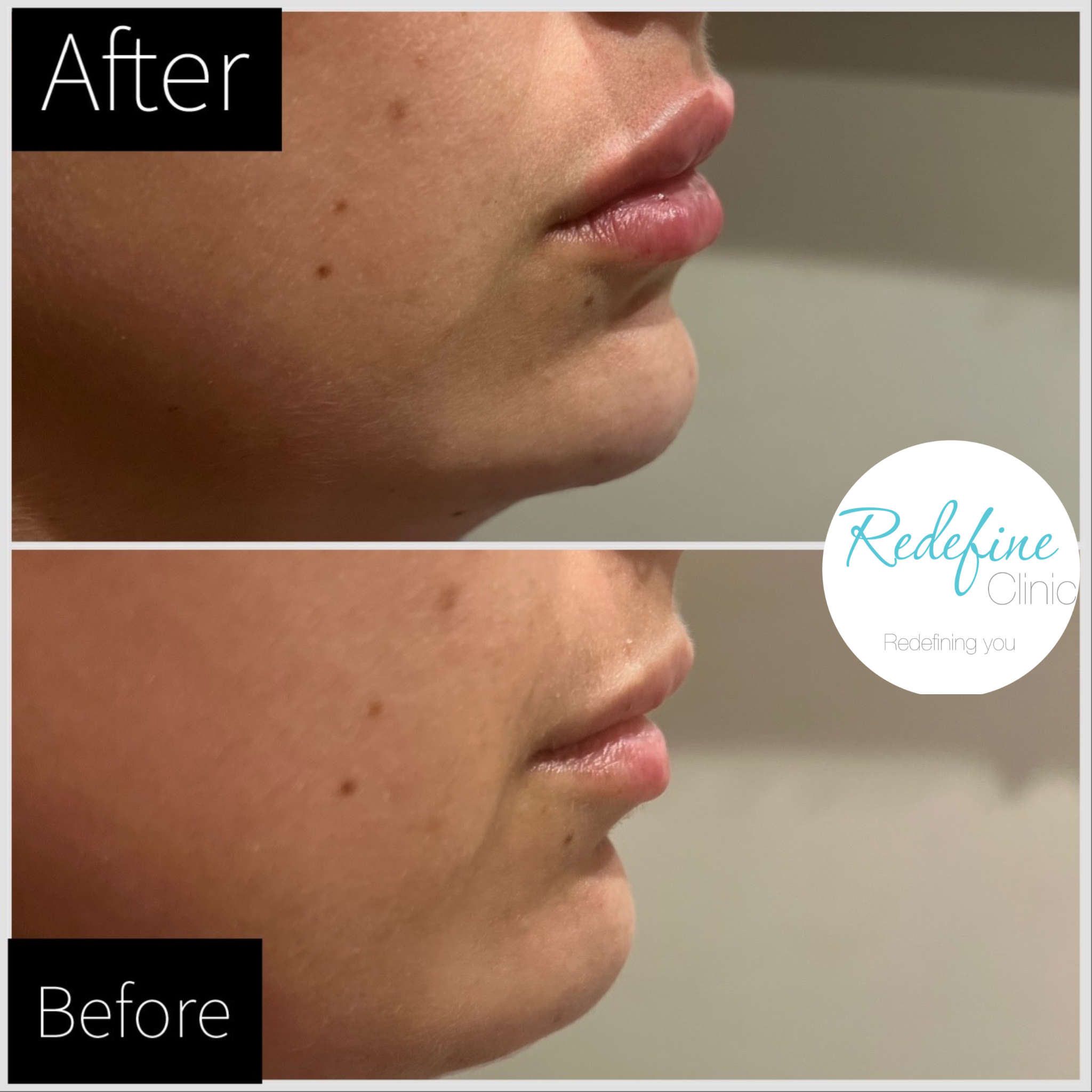 Close-up side view of a person's face showing smoother skin after a cosmetic treatment, with the words 'After' in the top left corner and 'Before' in the bottom left corner.