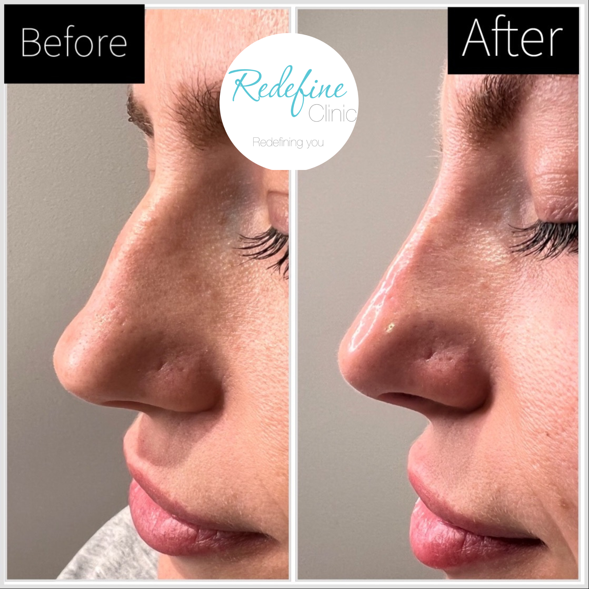 Side-by-side comparison of a person's nose before and after skin treatment, showing smoother skin in the after image.