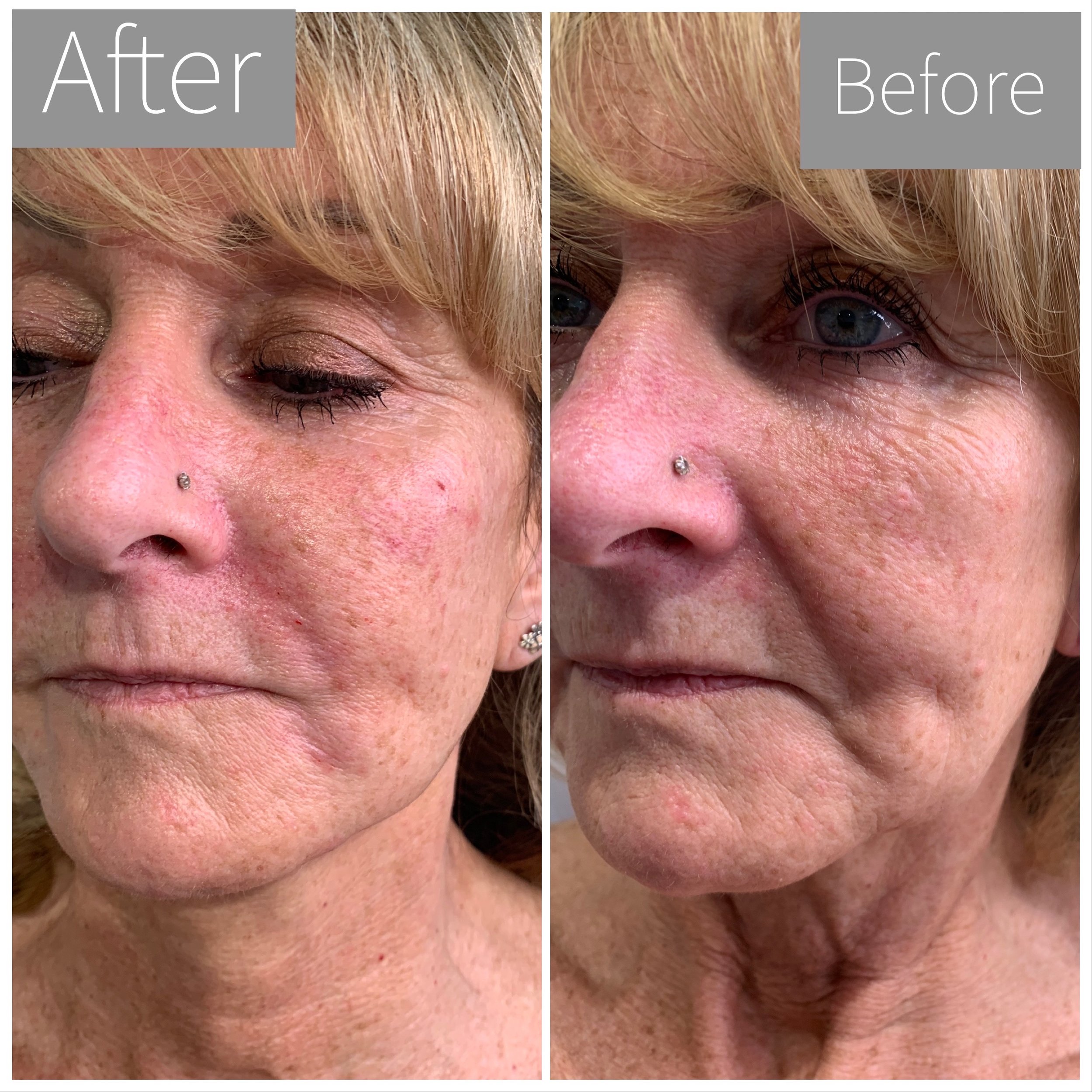 Comparison of a person's face before and after a cosmetic or skincare treatment, showing improvements in skin texture and appearance around the eyes and nose.