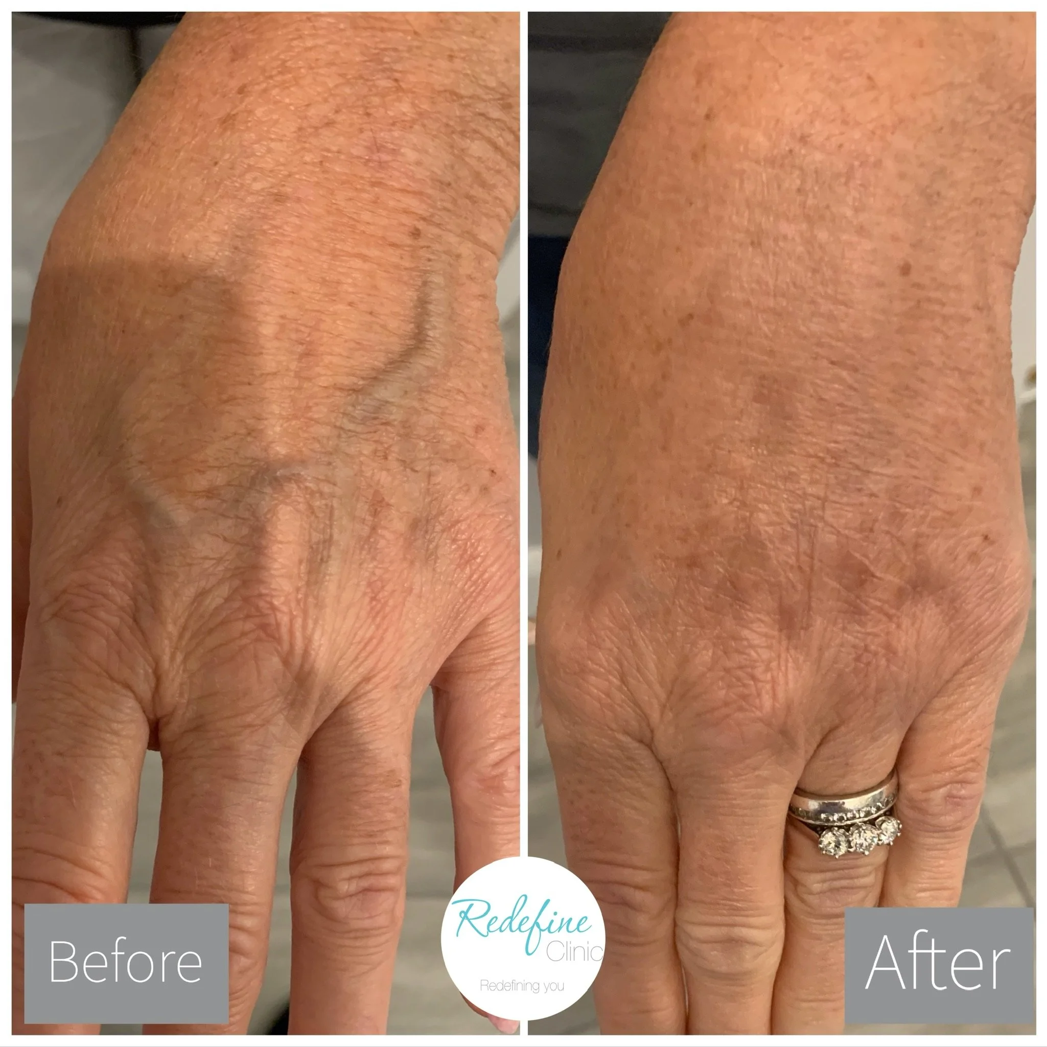 Comparison image showing the back of a hand with dry, wrinkled skin on the left side and smoother, more hydrated skin on the right side, indicating skin improvement.