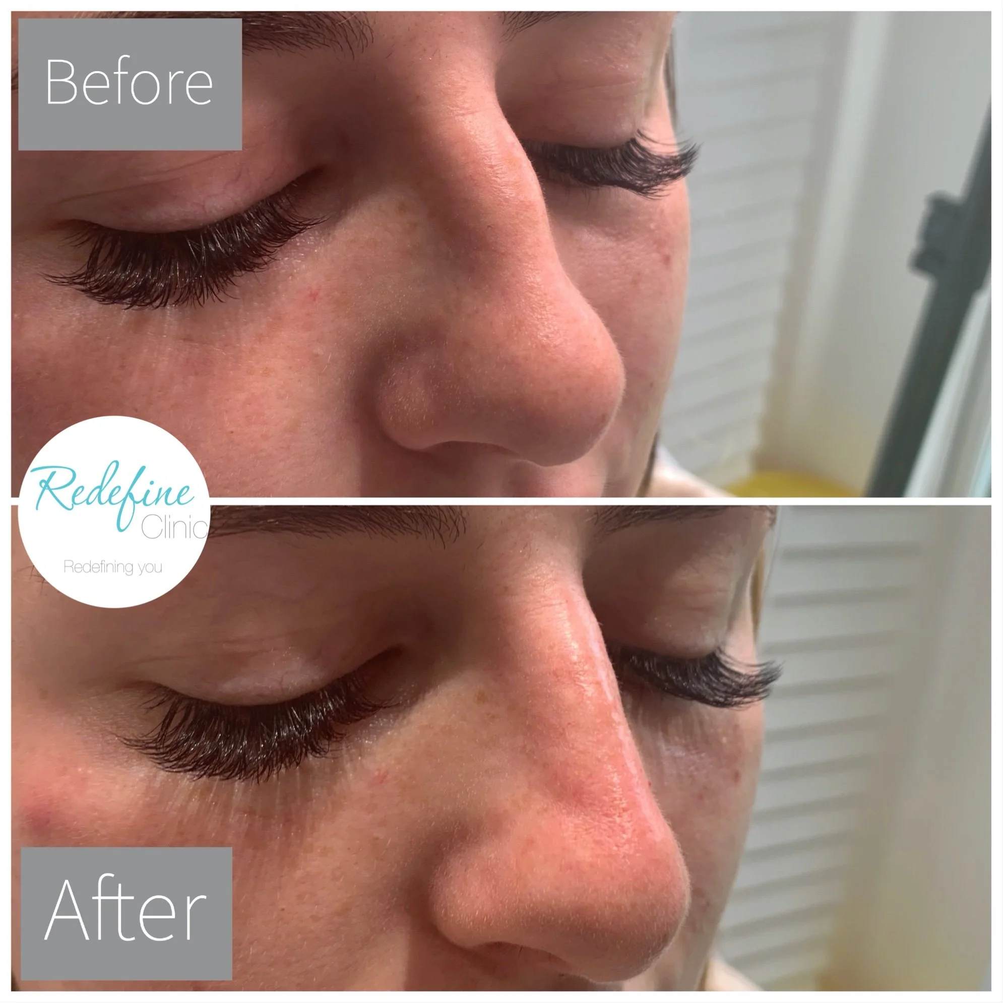 Close-up of a person's face showing the nose, closed eyes with long eyelashes, and part of forehead, with the words 'Before' and 'After' overlaid.