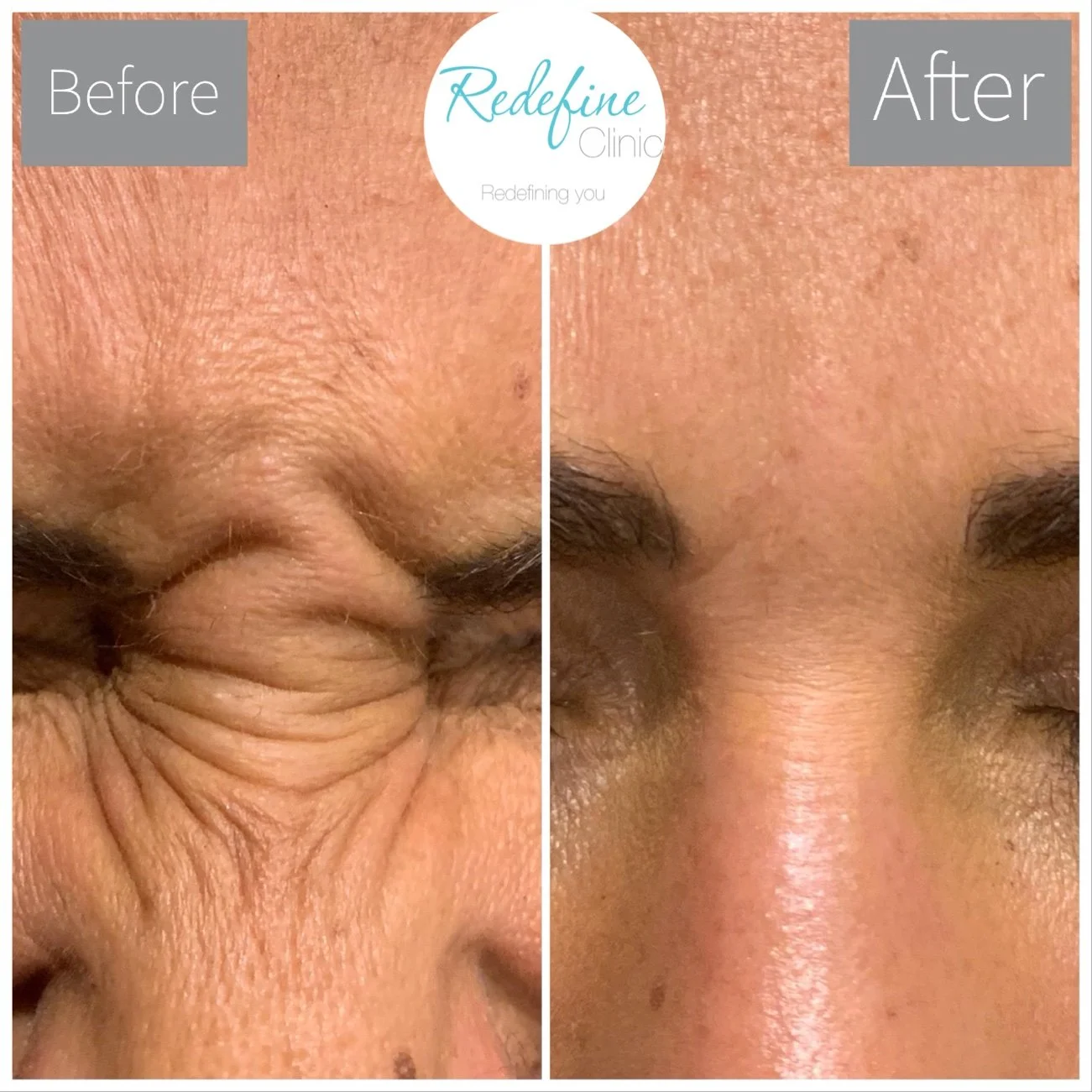 Before and after close-up images of a person's forehead and eyebrows showing skin improvement, with the brand 'Redefine Clinic' and the tagline 'Redefining you' at the top.
