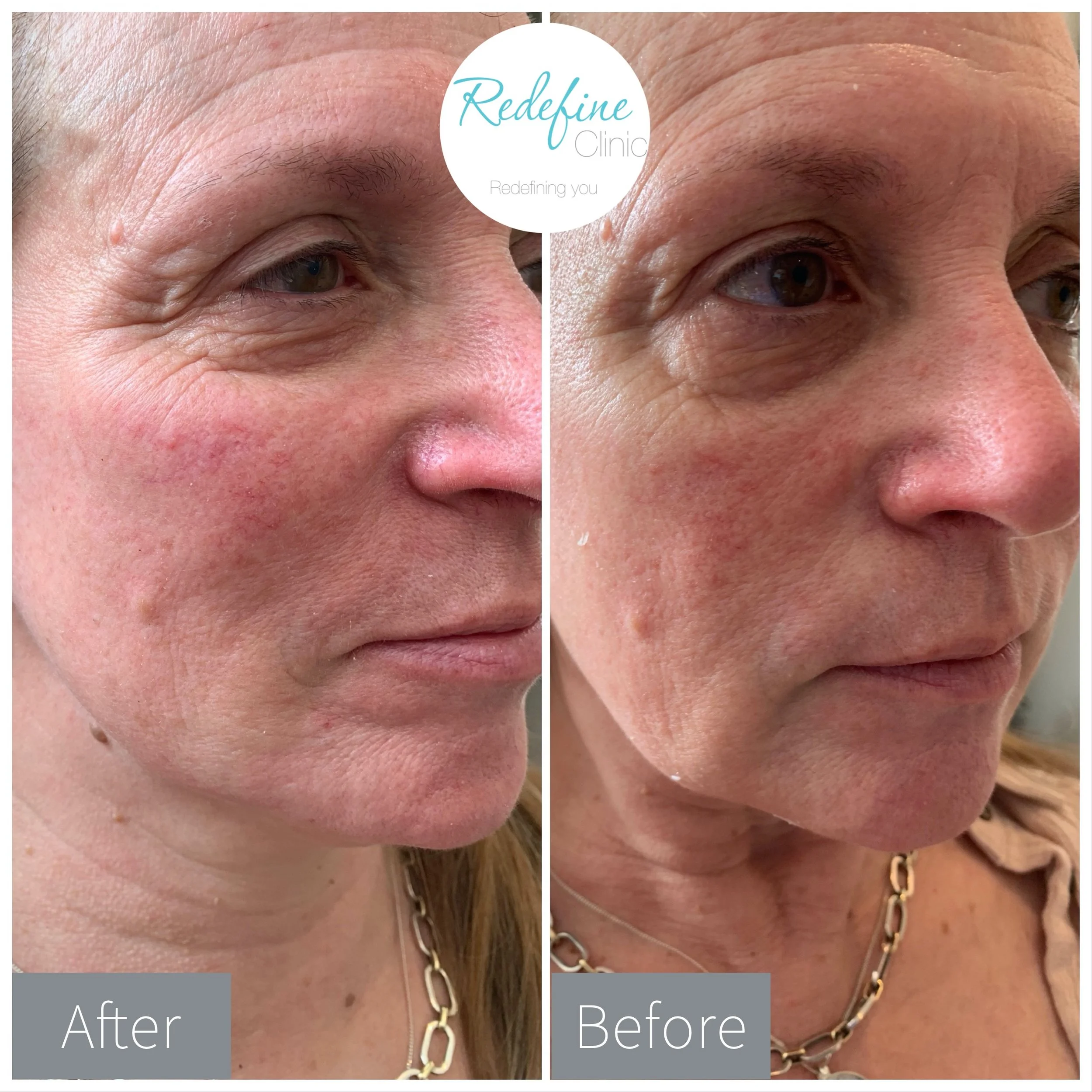 Close-up of a woman's face showing before and after images of skin around her eye, with the after image on the left and the before image on the right. The images highlight changes in skin texture and wrinkles. The woman is wearing a chain necklace in both images, and the background is neutral.