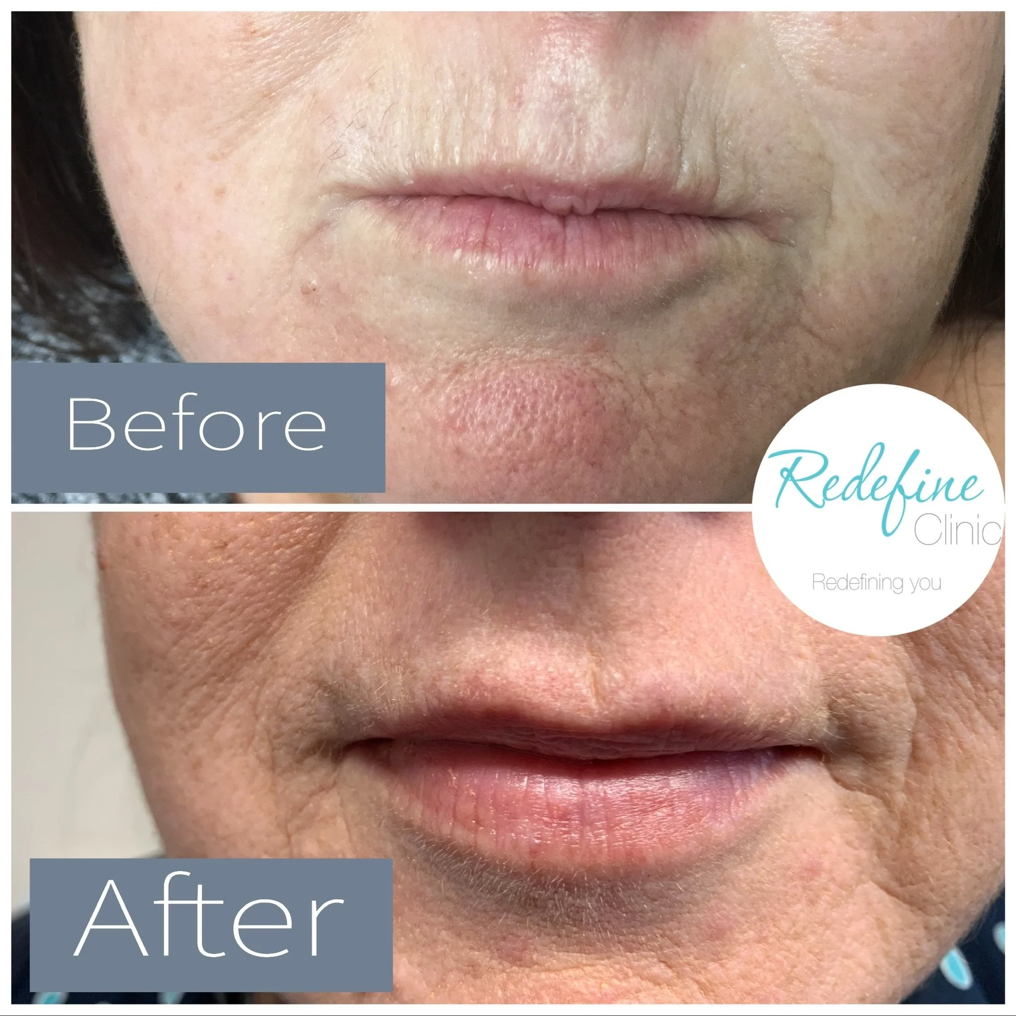Close-up image showing skin on a person's face, focusing on the area around the lips. The image is labeled 'Before' and 'After', indicating a comparison likely related to skincare or cosmetic treatment.