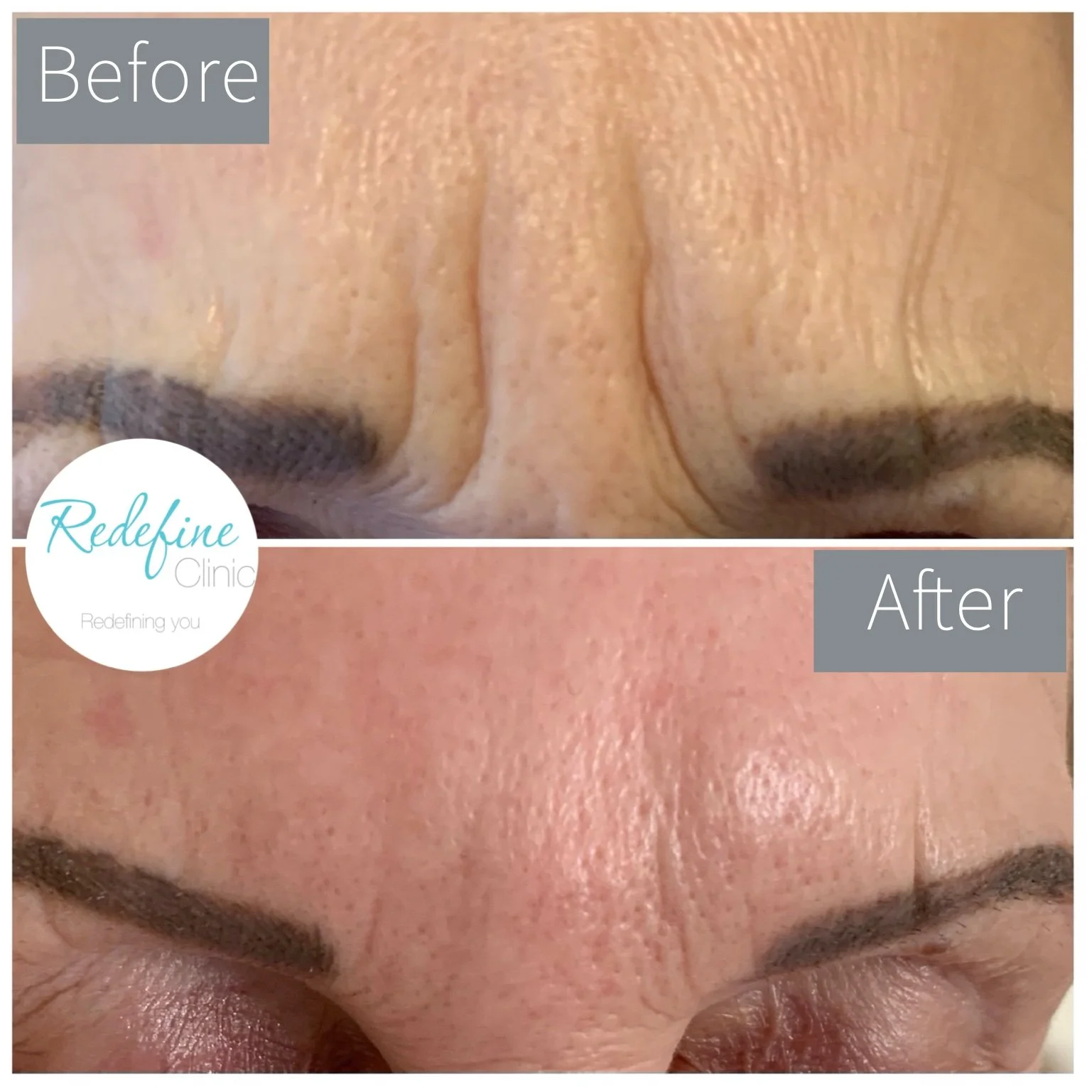 Comparison of a person's forehead before and after skincare treatment showing reduction in wrinkles, with a focus on smoother skin in the after image, featuring branding from Redefine Clinic.