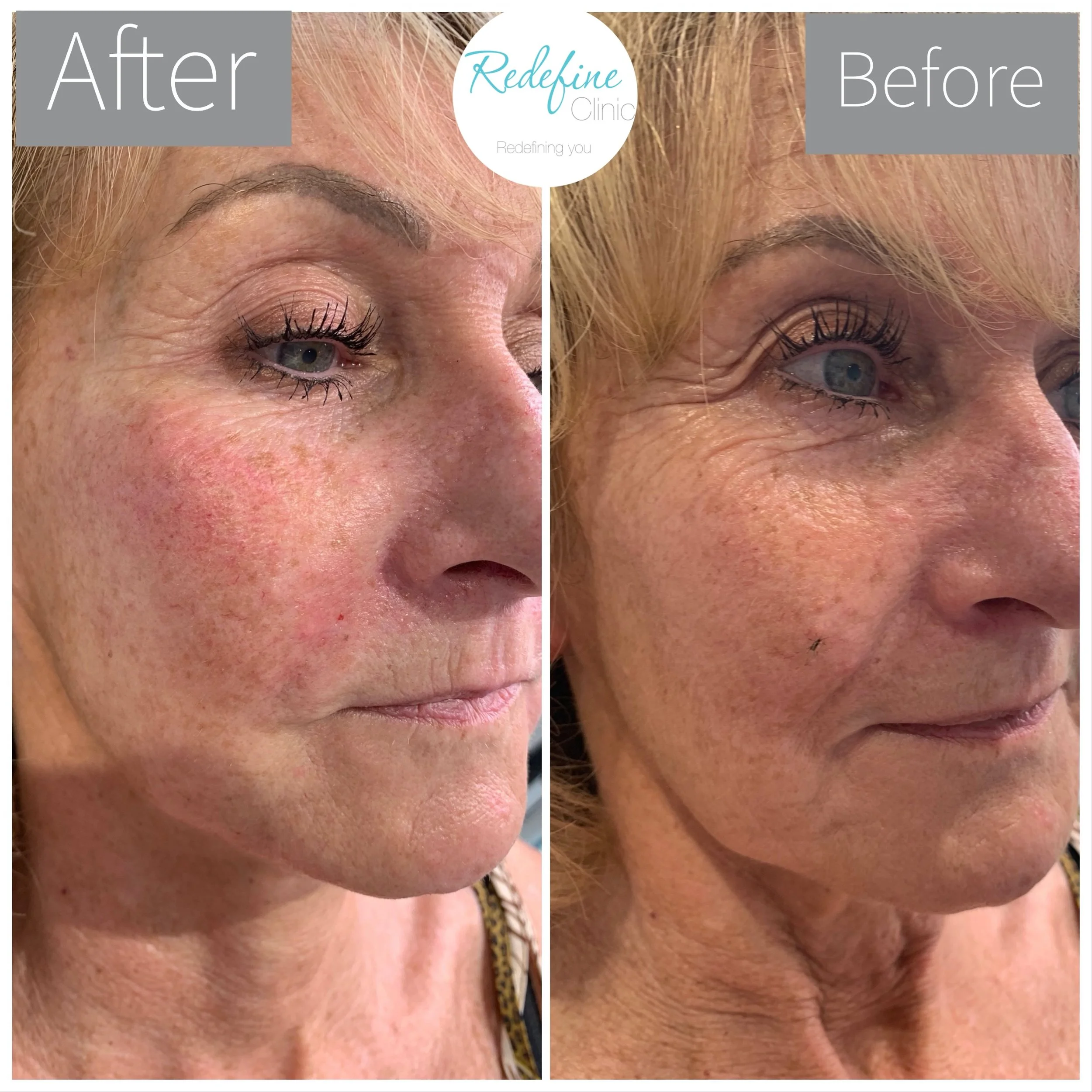 Close-up comparison of an elderly woman's face showing a before and after of a cosmetic eye treatment, highlighting smoother skin and reduced wrinkles around the eye area.