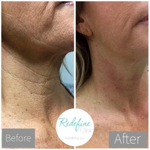 Comparison of a person's neck showing skin improvements from before to after treatment at Redefine Clinic.