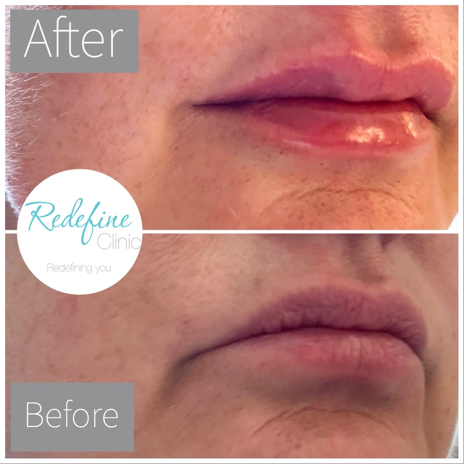 Close-up of a person's lips showing a before and after comparison, with the top section labeled 'After' and the bottom section labeled 'Before,' featuring clear skin and lips in the "After" section.