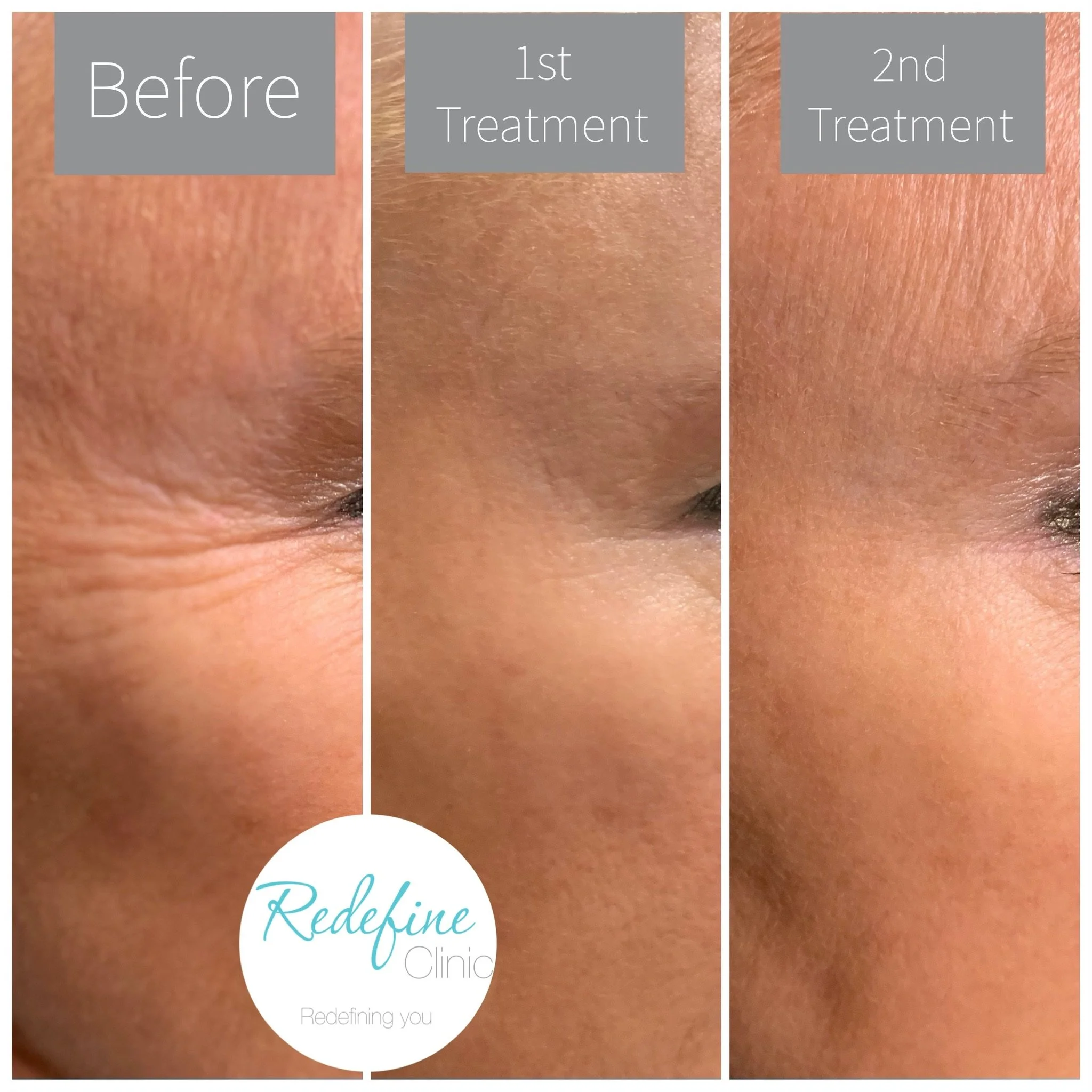 Close-up image showing before and after images of skin treatment on a person's forehead, with textual overlays indicating steps: 'Before', '1st Treatment', and '2nd Treatment', along with a logo for 'Redefine Clinic' and the tagline 'Redefining you'.
