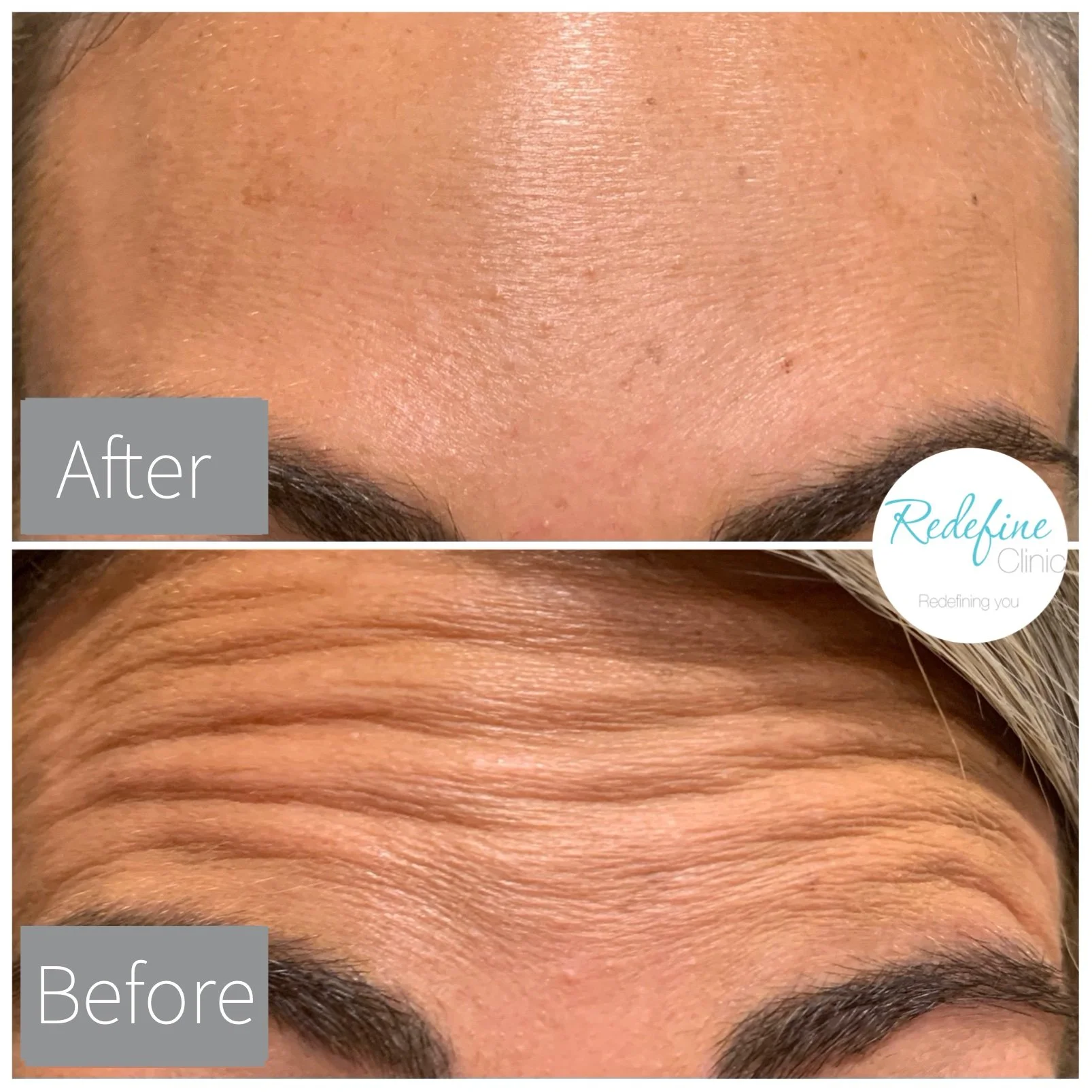 Close-up of a person's forehead showing before and after skin treatment results, with smoother skin and reduced wrinkles in the after image.