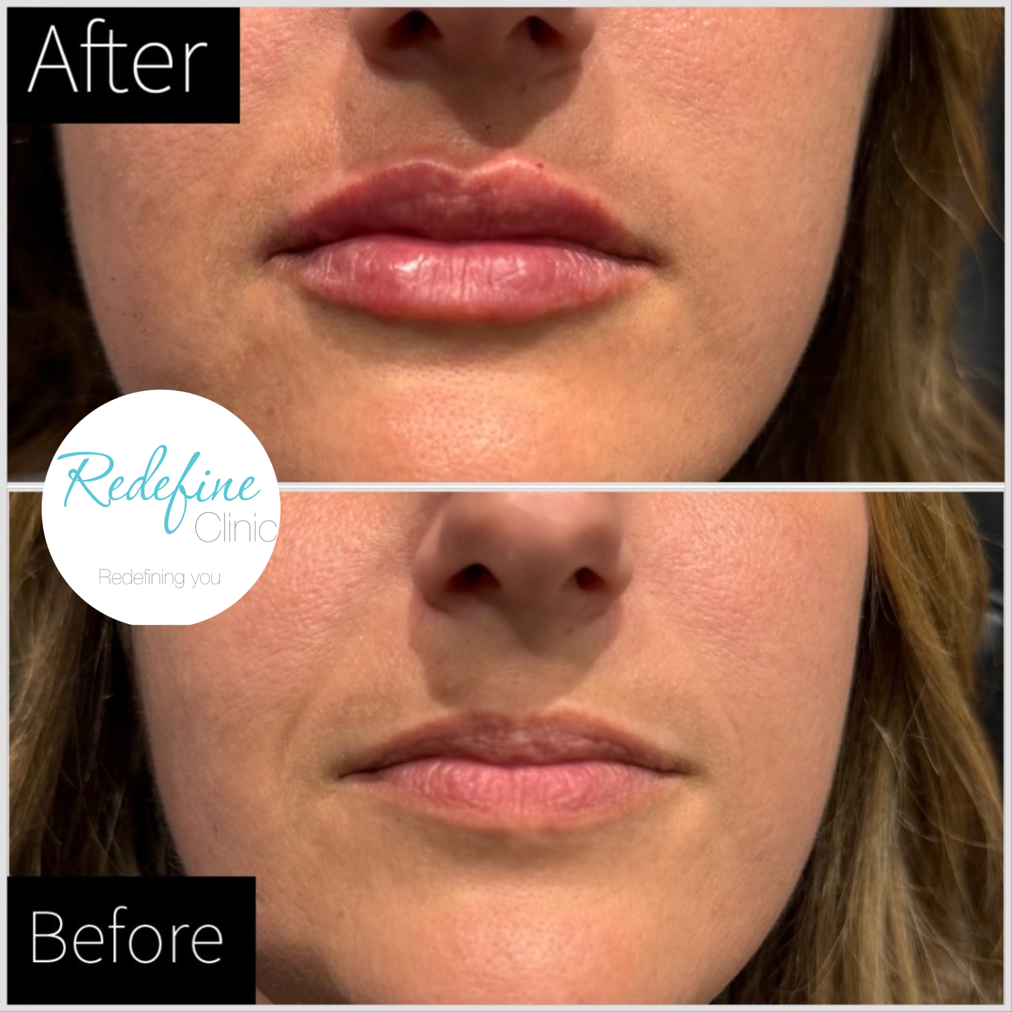 Close-up of a woman's face showing the lower half, including nose, lips, and chin, with the words 'After' and 'Before' overlaid on the image.