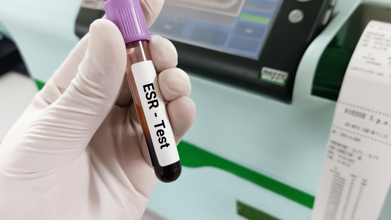 ESR vs. CRP: Why Your RA Labs Are "Normal" But You Still Have Pain