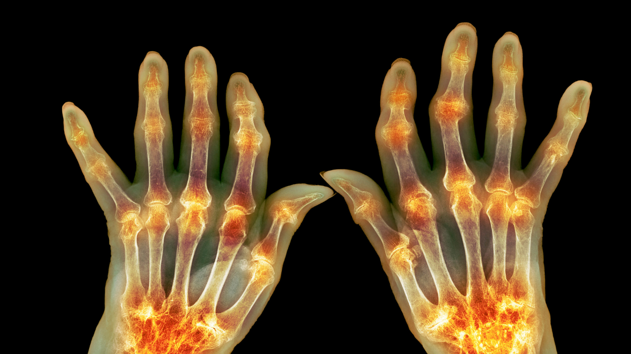 Why RA Flares Hit After Stress Finally Ends