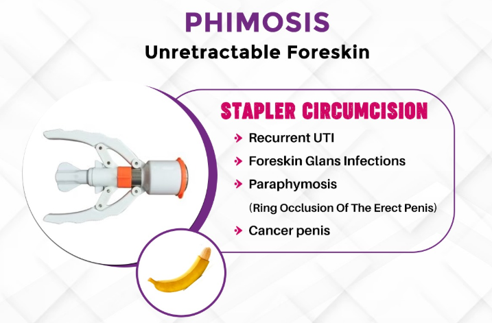 Stapler Circumcision Service